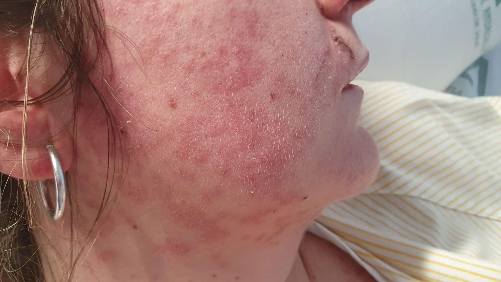 Lesiones faciales de lupus cutáneo agudo.