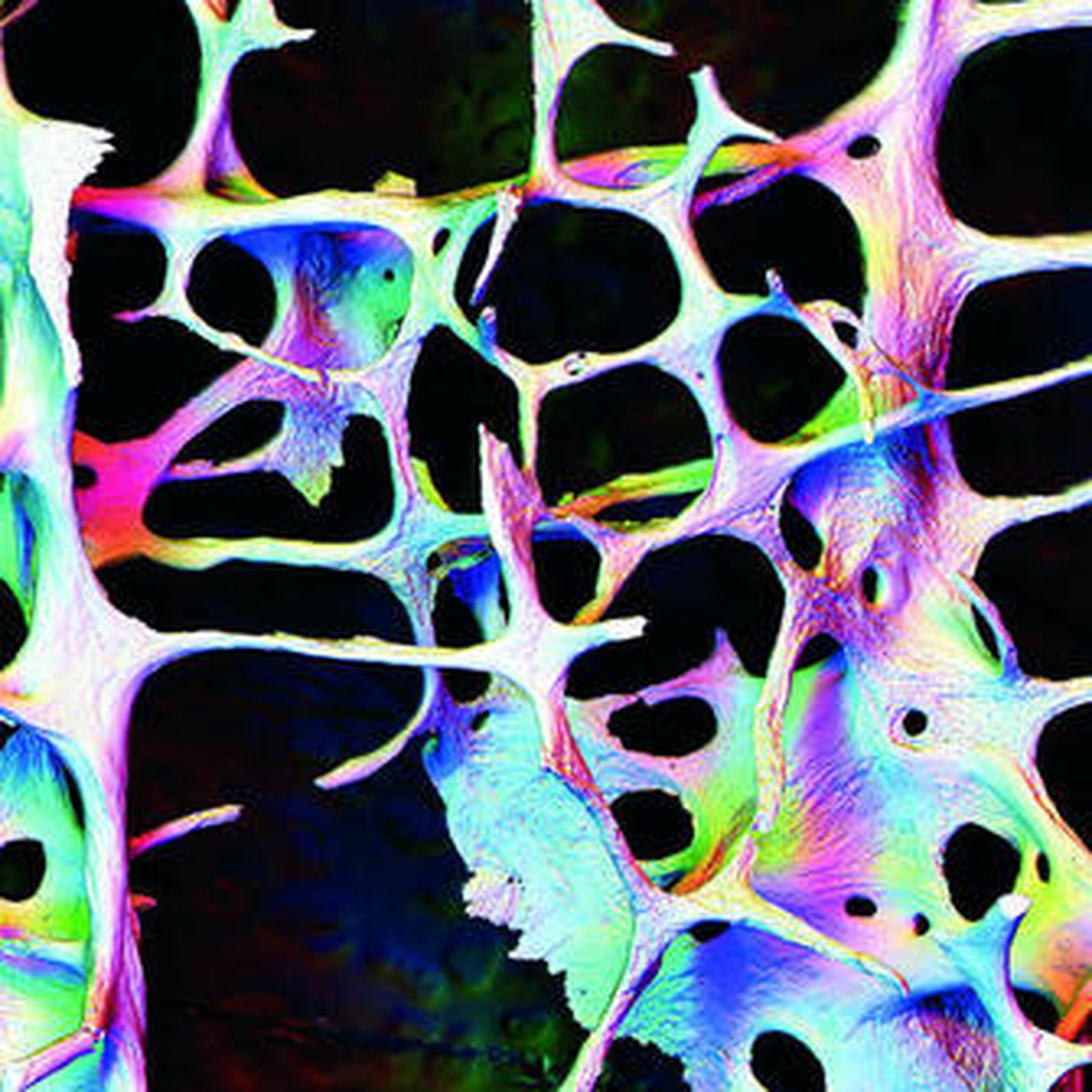 Hueso afectado al microscopio.