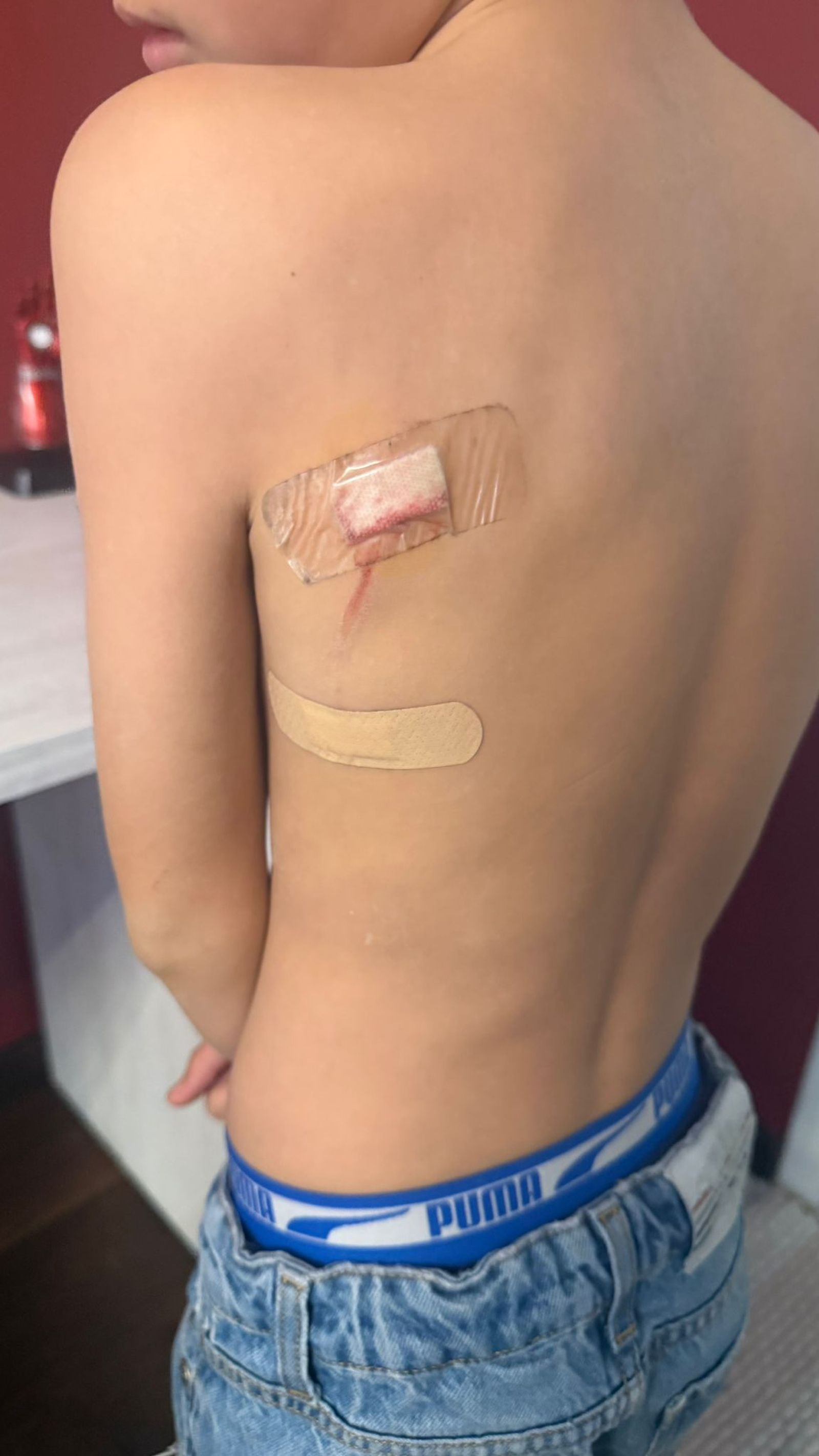 El menor que fue atacado por el perro en Marbella