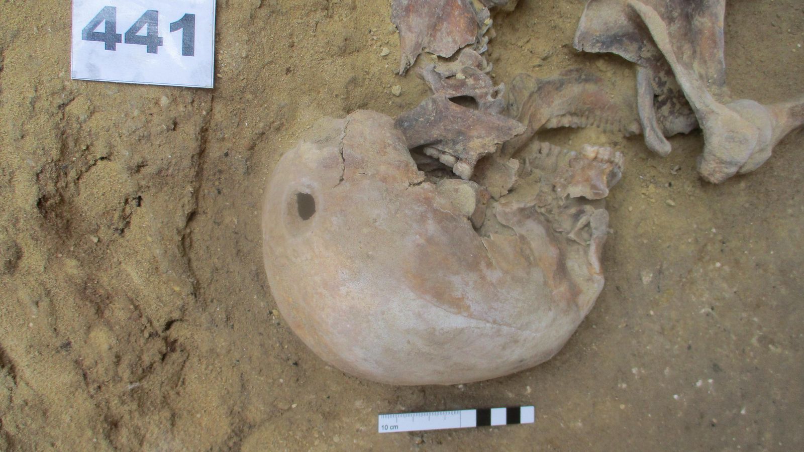 El sujeto 441 de las excavaciones en el cementerio de San Fernando con un agujero de bala en el cráneo.