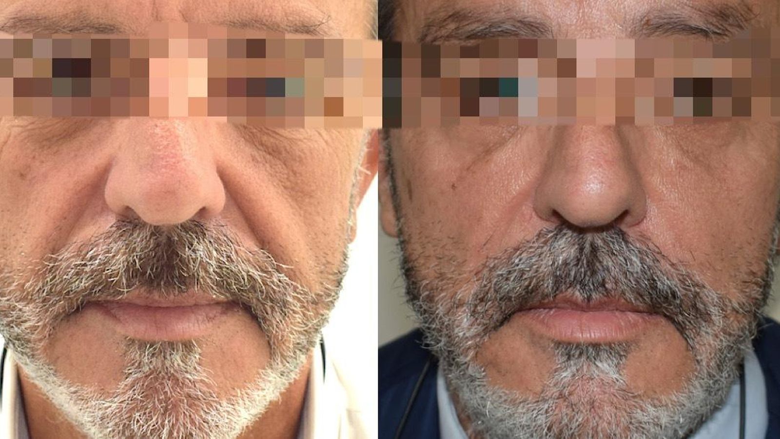 Técnicas de rejuvenicimiento donde se deja patente la diferencia del antes y el después.