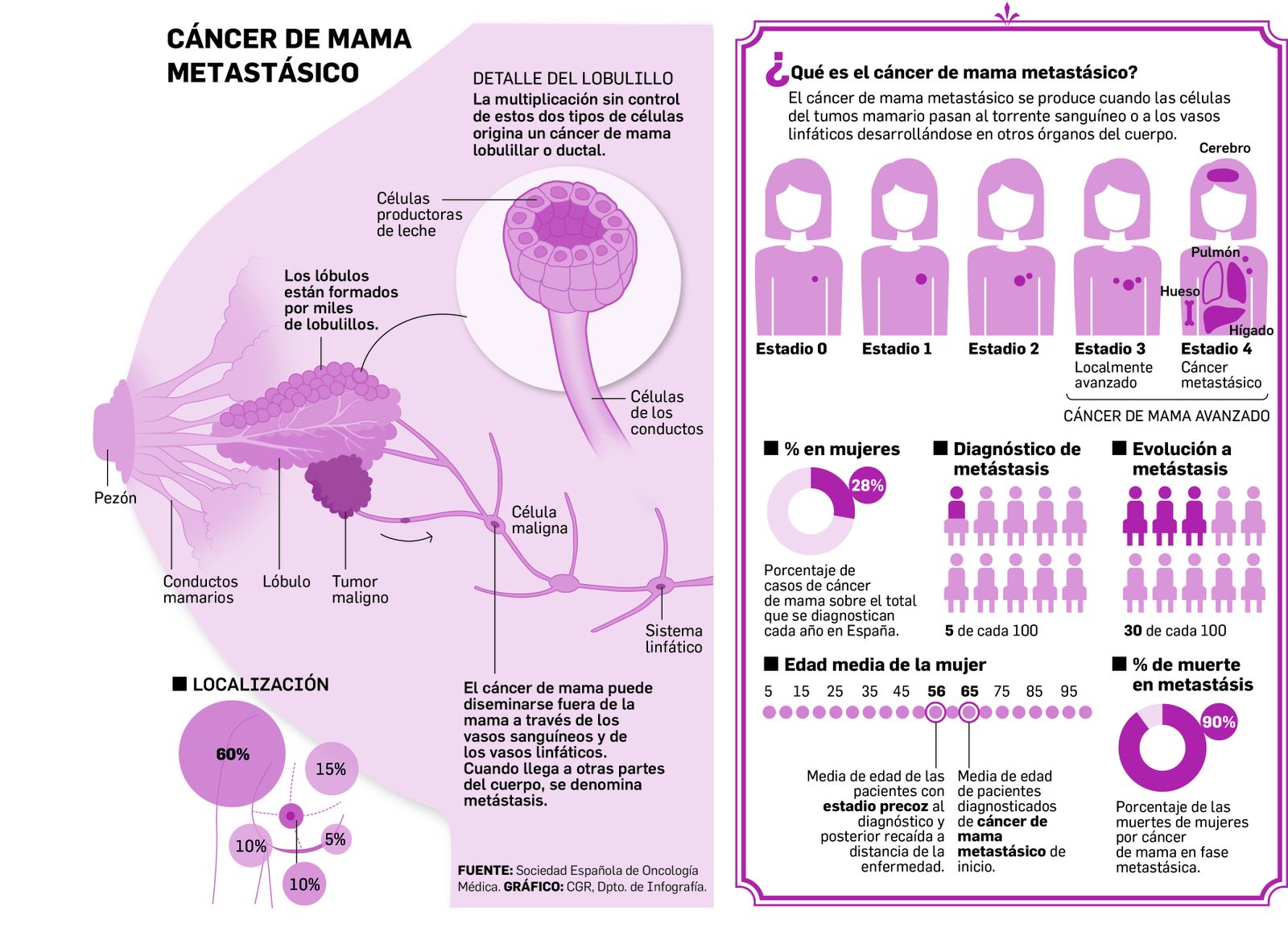Cáncer de mama metastásico