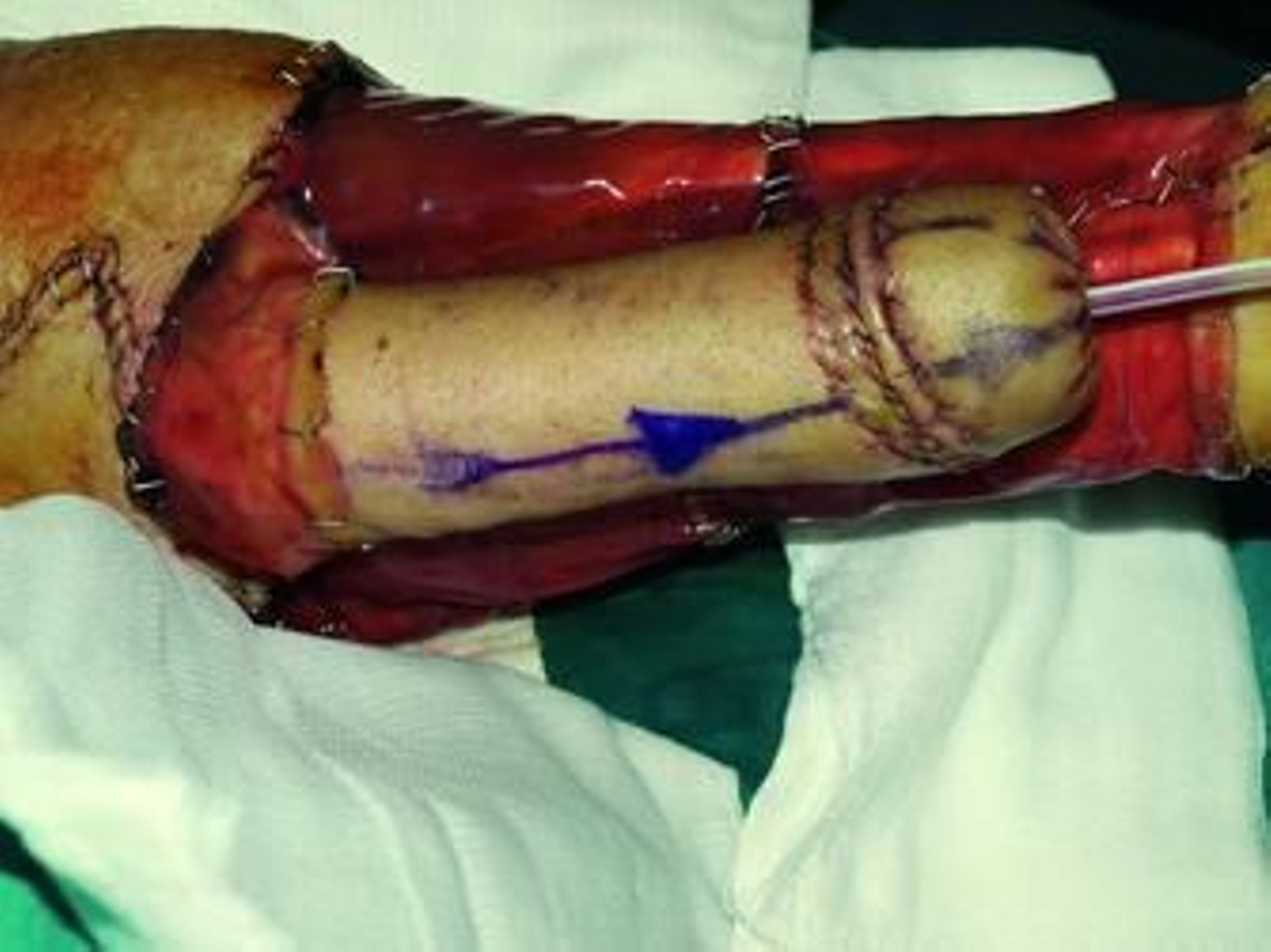 Primera operación: se hace el pene artificial enrollando piel y grasa del antebrazo del propio paciente.