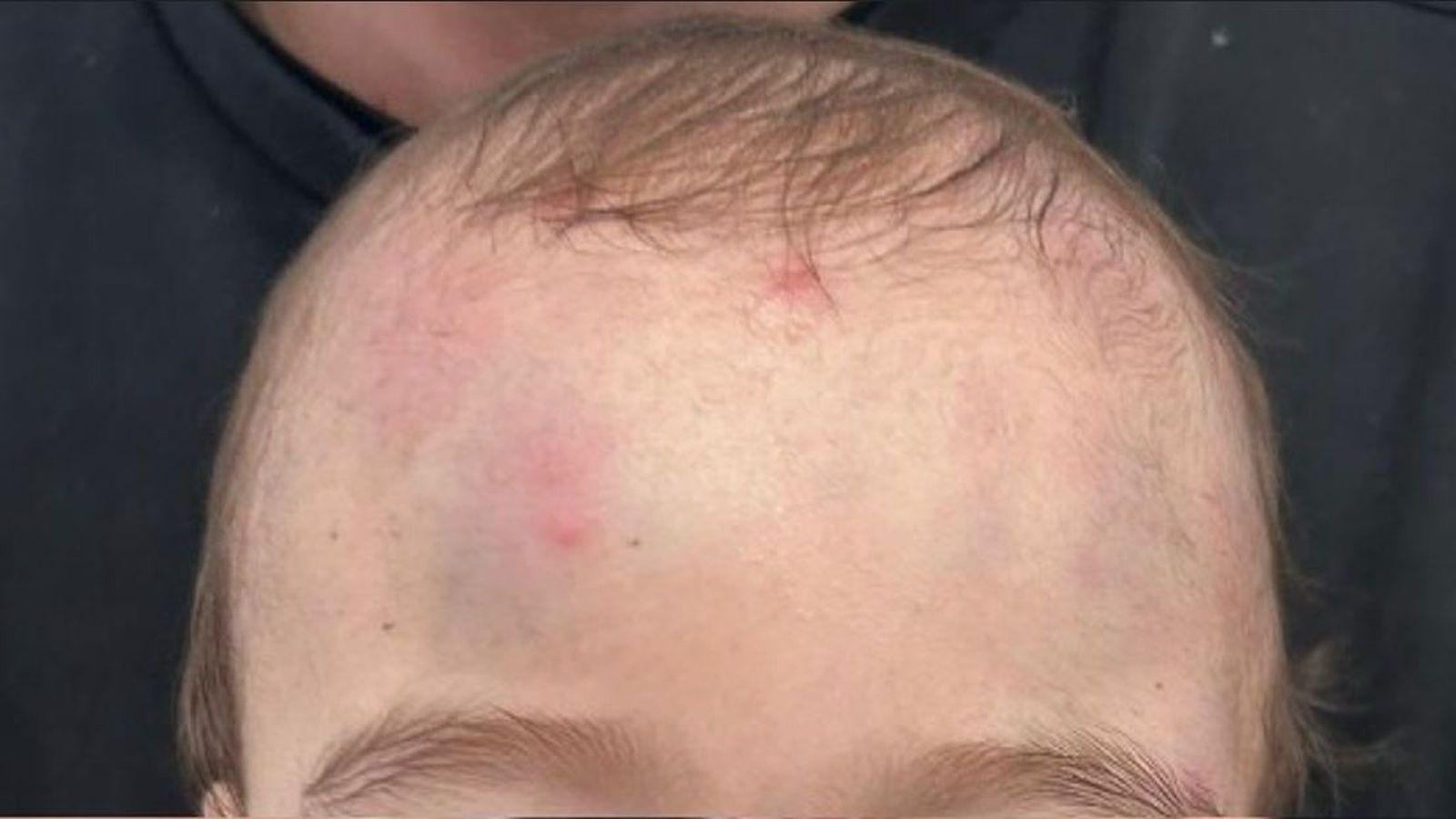 Imagen parcial del menor, con la cabeza llena de hematomas.