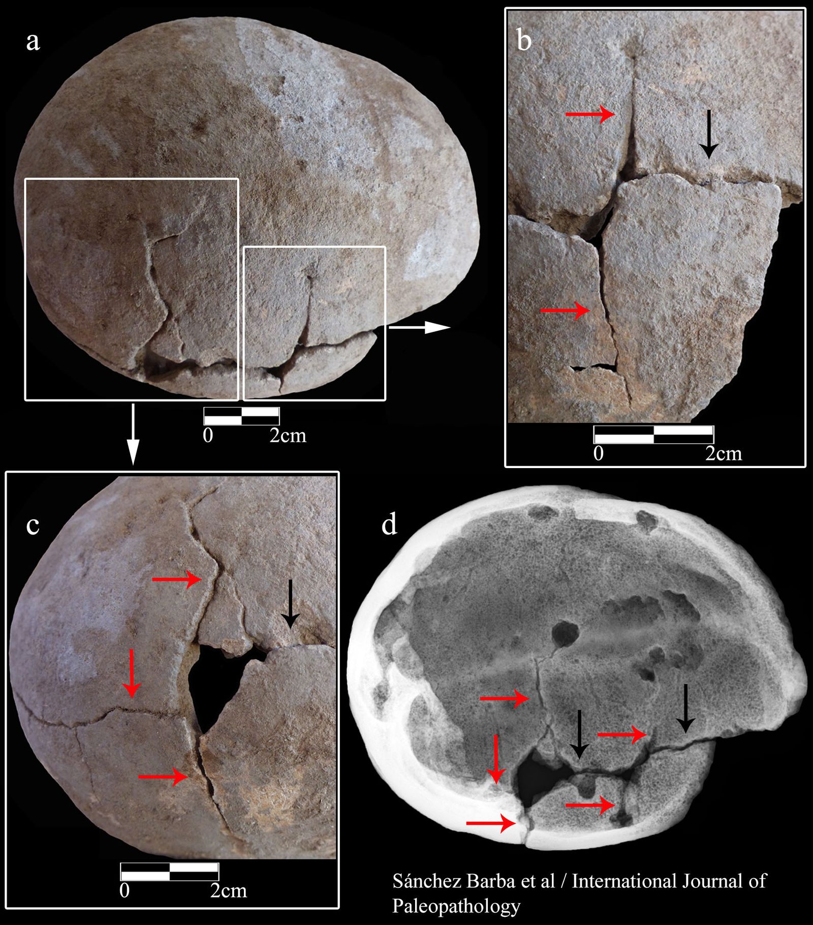 Signos de violencia en uno de los cráneos.