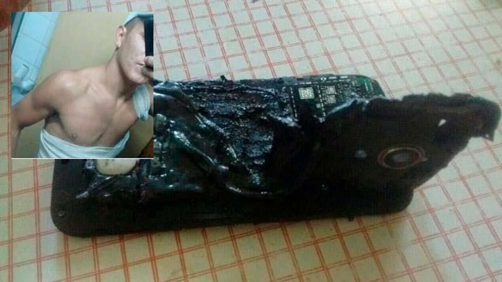 Graves quemaduras tras explotarle  el móvil mientras dormía