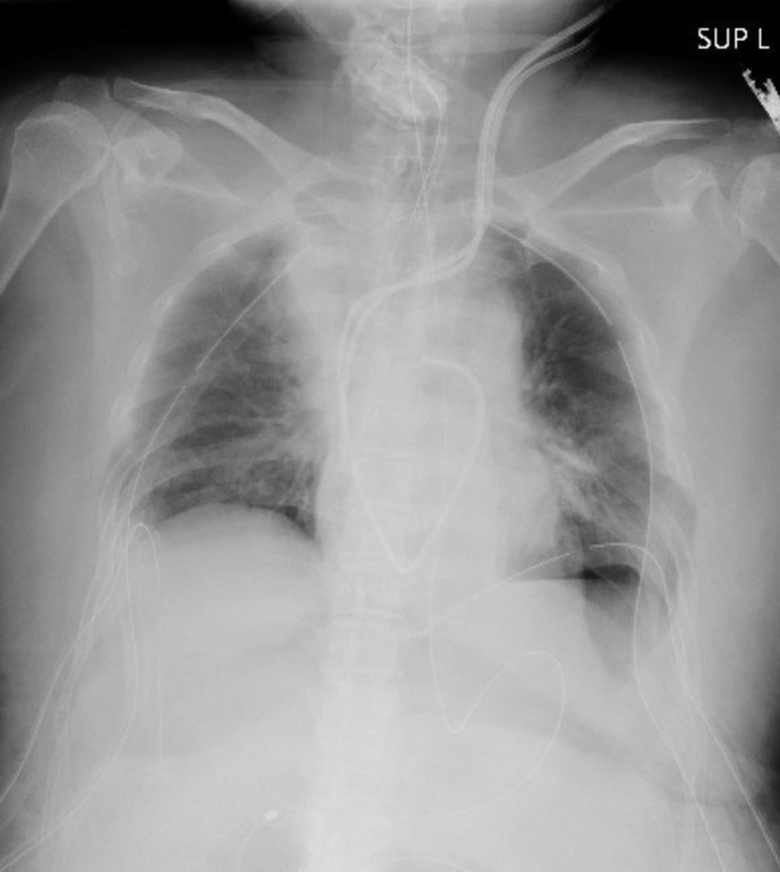 Radiografía pulmonar de la primera paciente del mundo en recibir un trasplante de pulmón desde pacientes vivos.