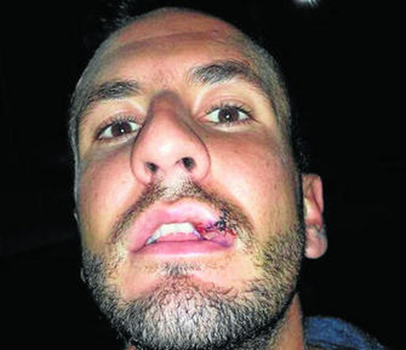 Andrés Ocaña mostraba ayer los siete puntos de sutura en el labio.