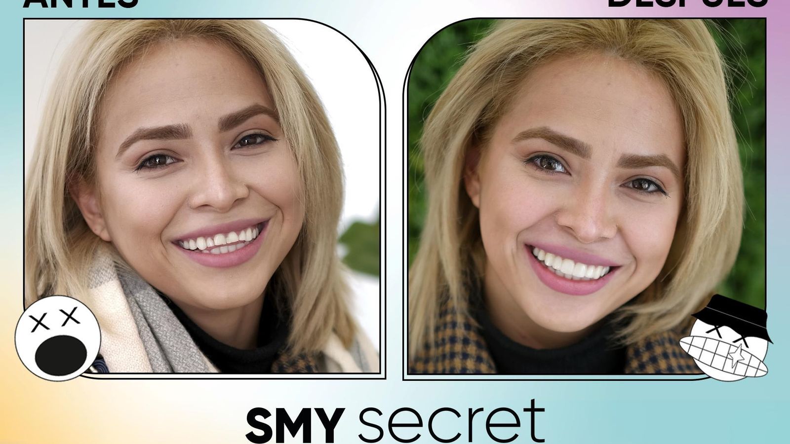 Carillas de composite inyectado