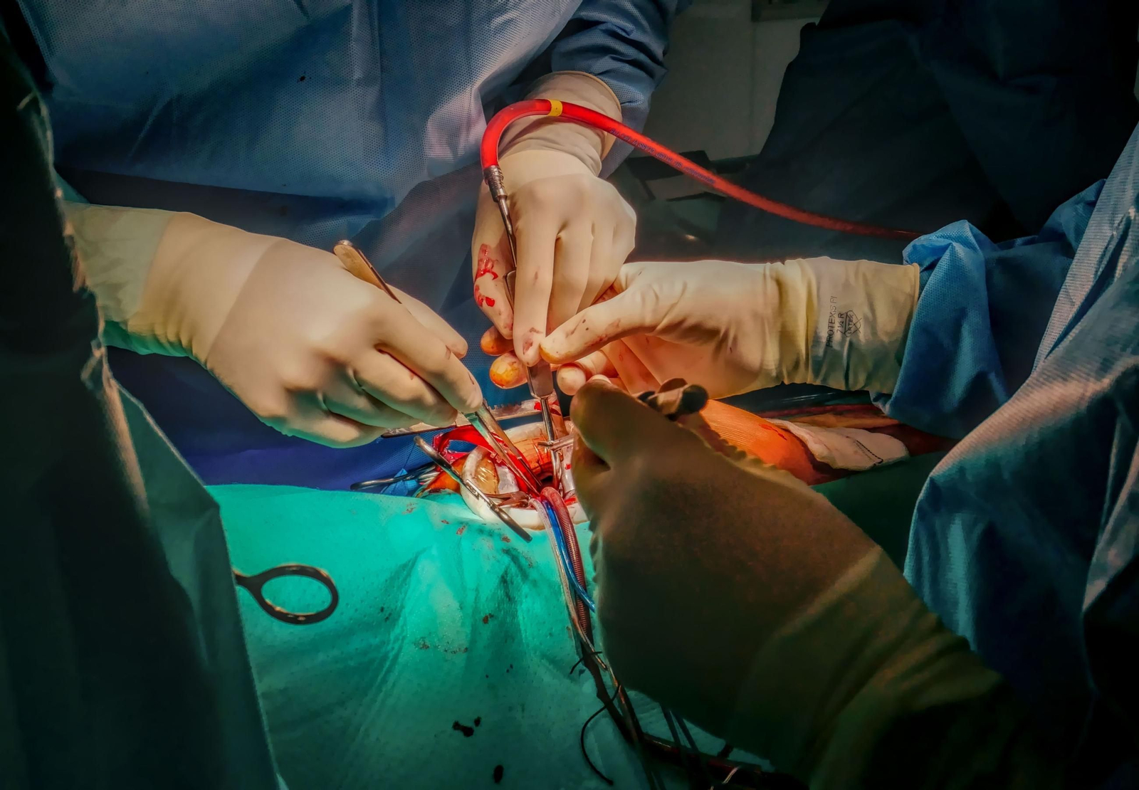 Dos cirujanos realizan una intervención de cardiología a un paciente con una técnica mínimamente invasiva.