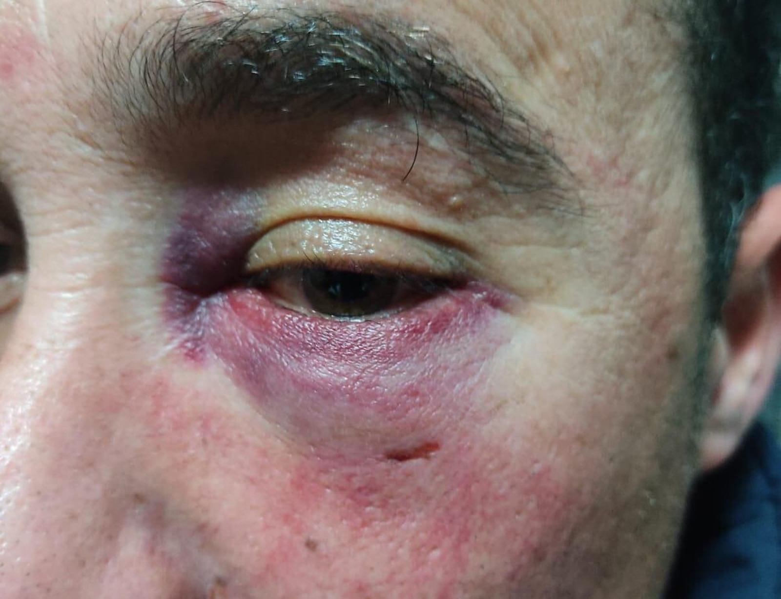 Fotografía del ojo izquierdo de Francisco José Sequera tras recibir un puñetazo.