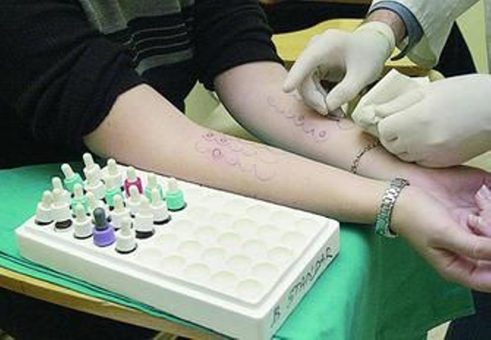 Una joven se somete a las pruebas de alergia en un hospital de Córdoba.