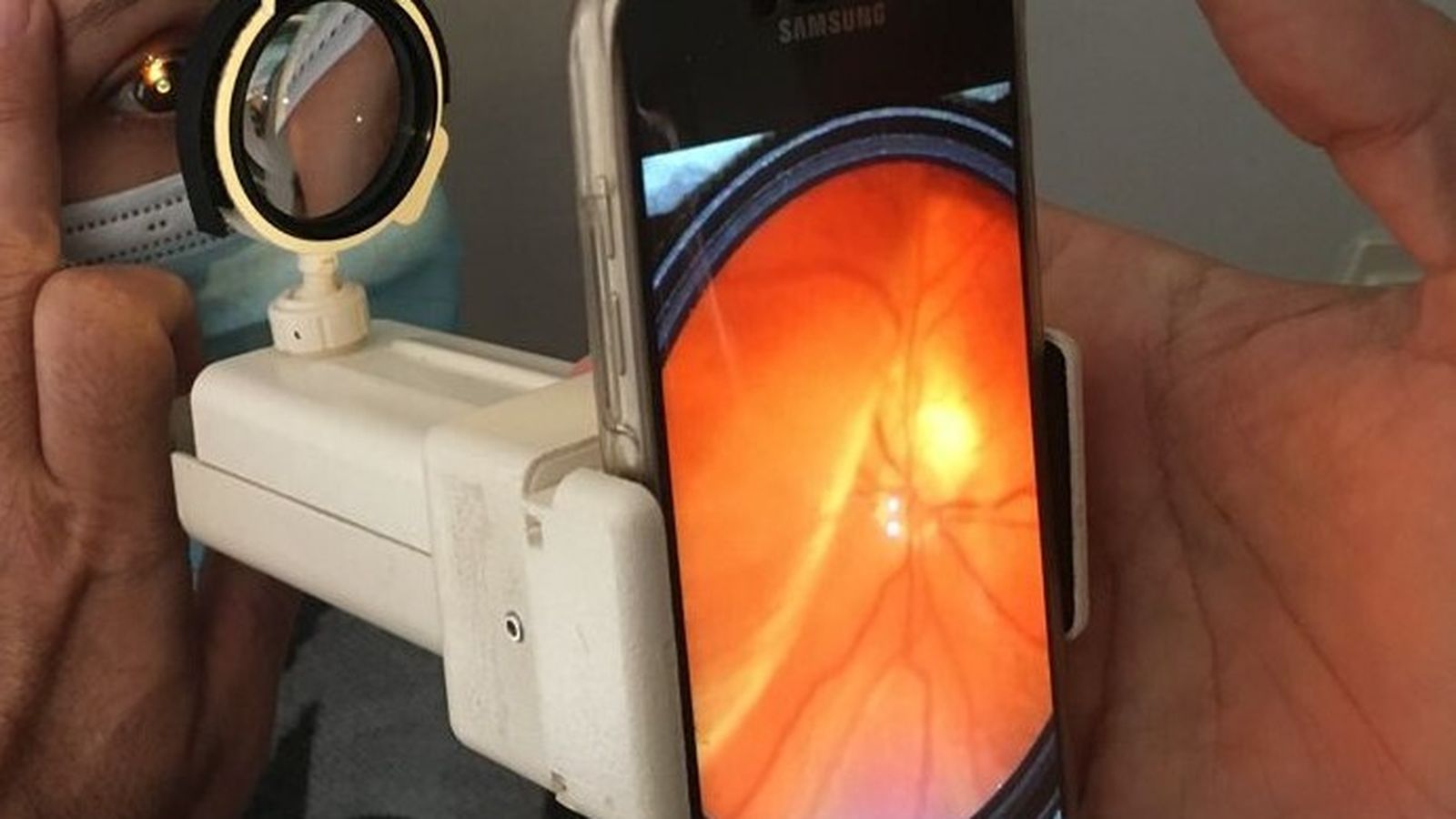 El Retinoscopio Abierto con un teléfono móvil acoplado.