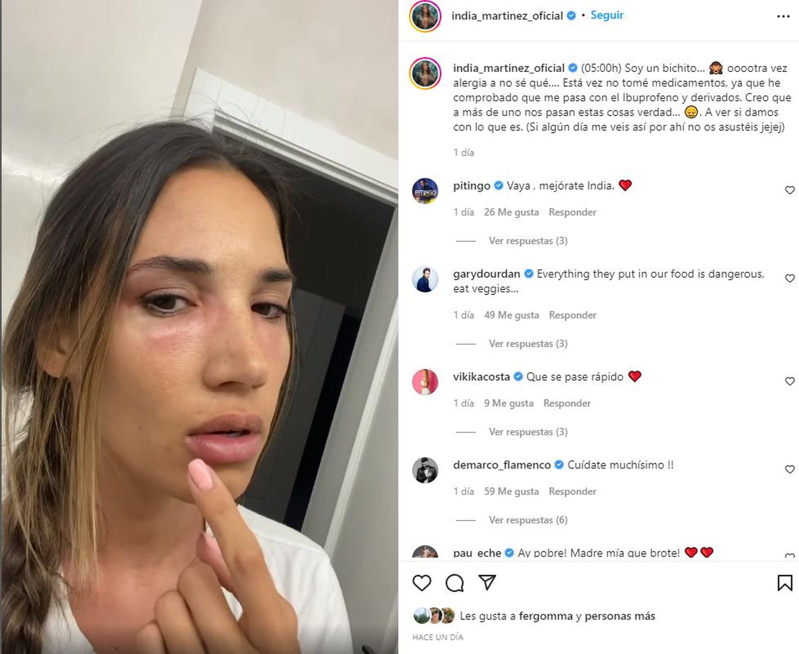 Una captura del vídeo publicado por la cantante con su cara hinchada.