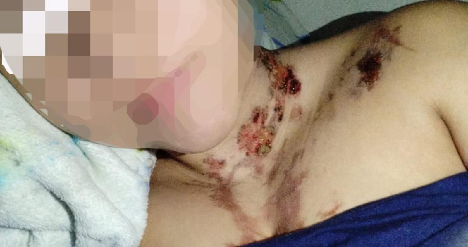 Imagen de la chica con las heridas provocadas por su pareja