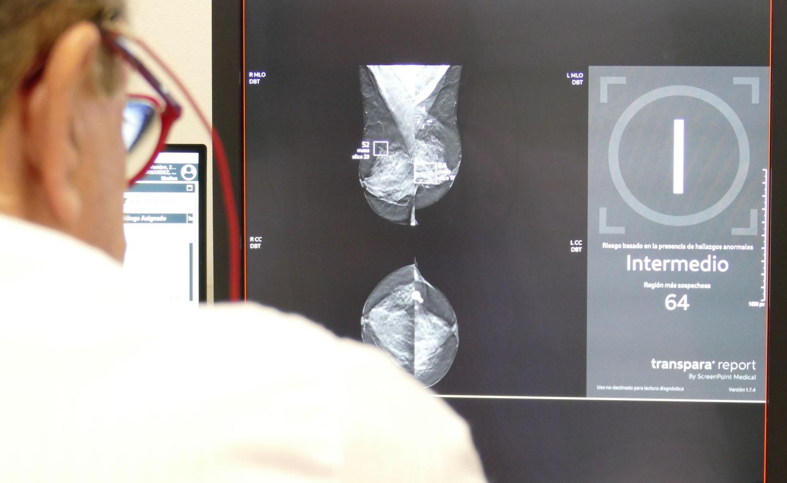 Imagen de archivo de la estadificación de riesgo de una mamografía