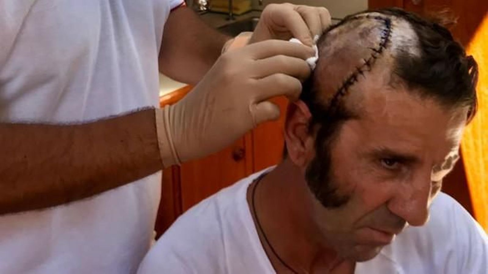 Cicatriz que ha dejado la cornada a Padilla.