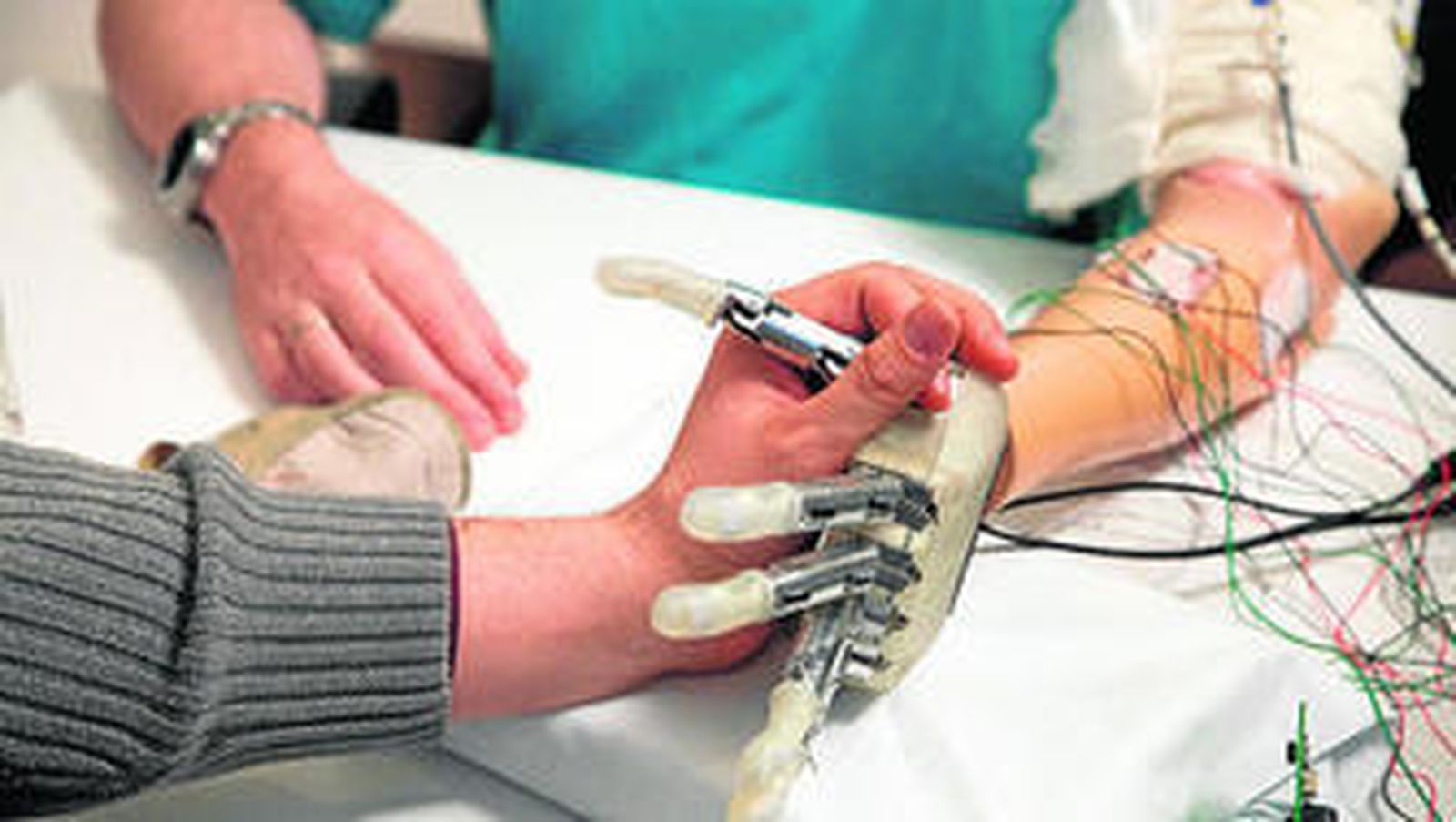 Una prótesis de un brazo en una paciente.