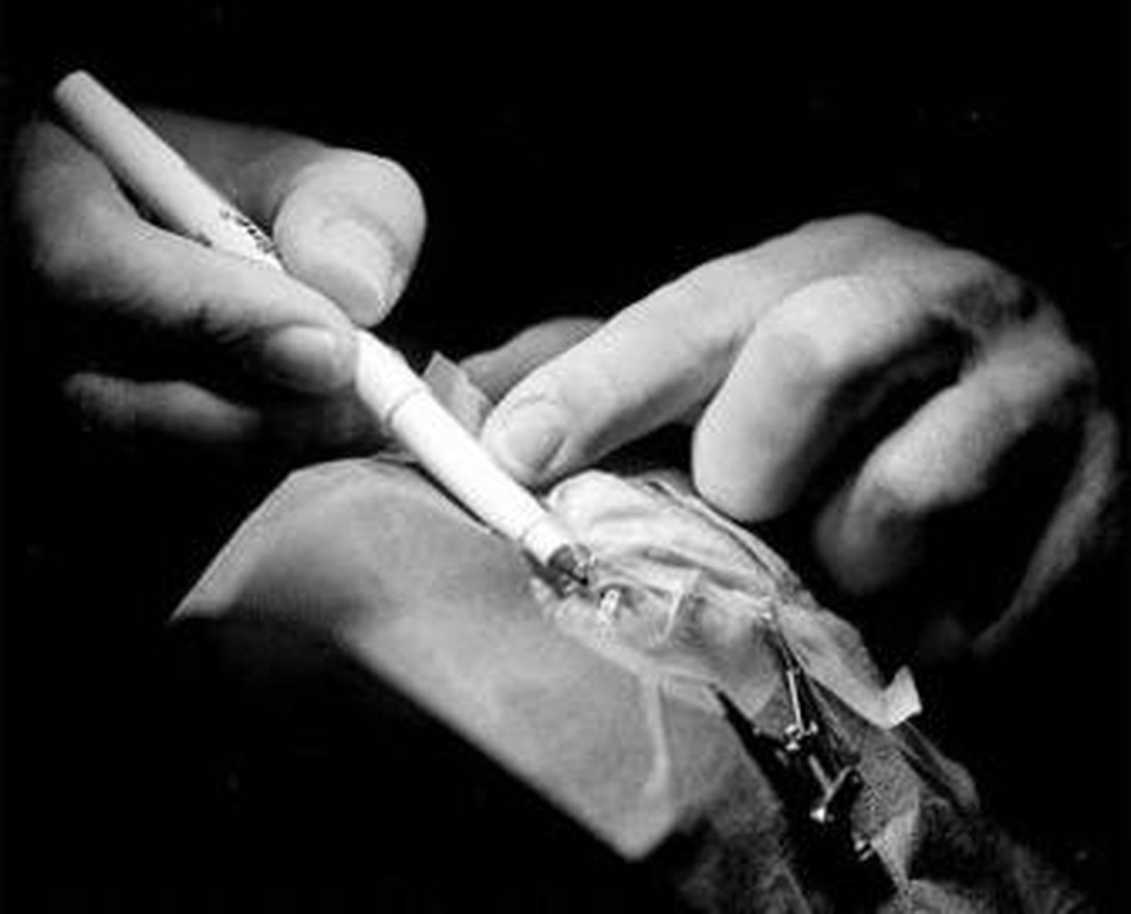 Imagen de archivo de los preparativos de un trasplante de córnea.