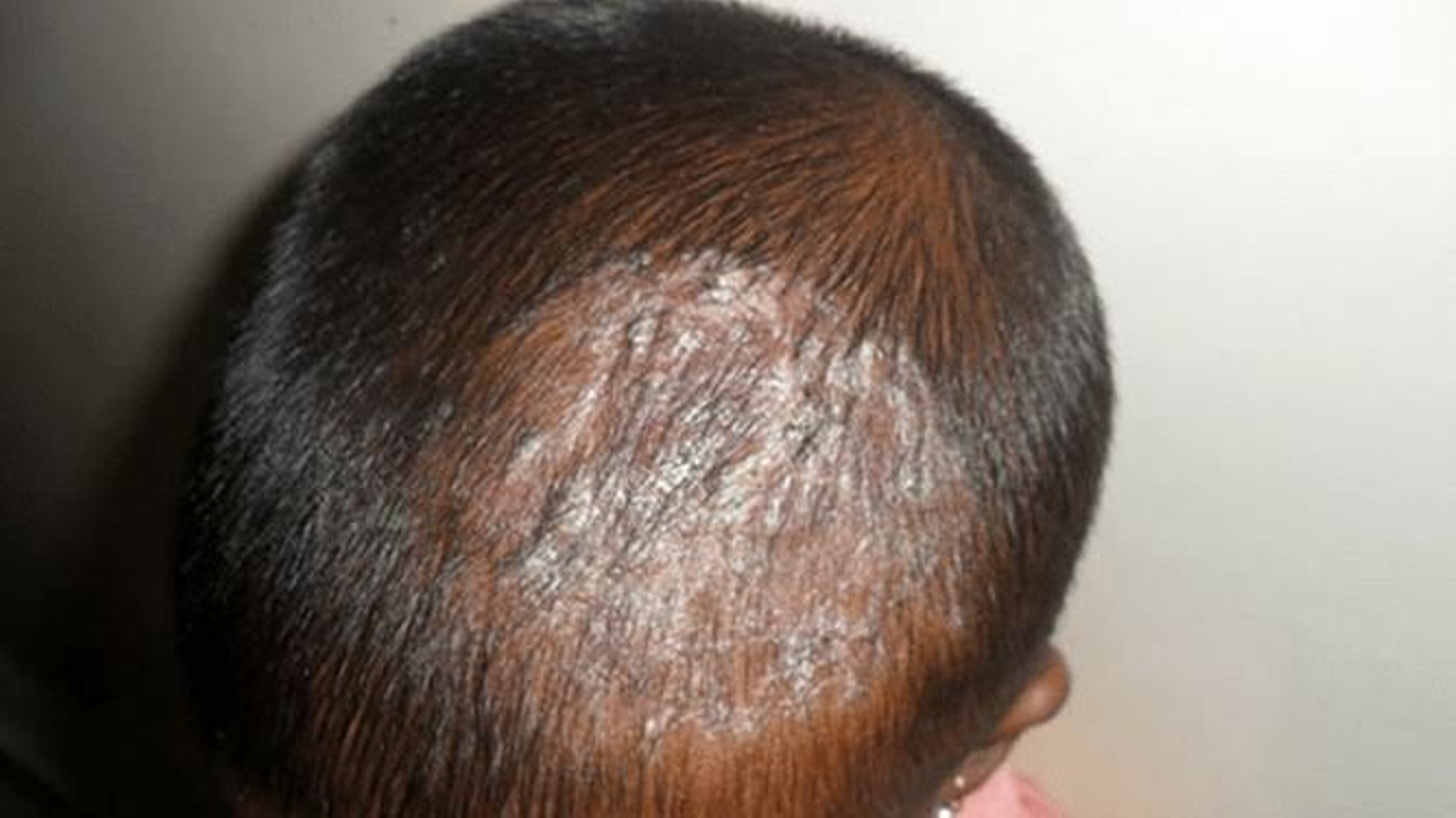 Una cabeza con tiña