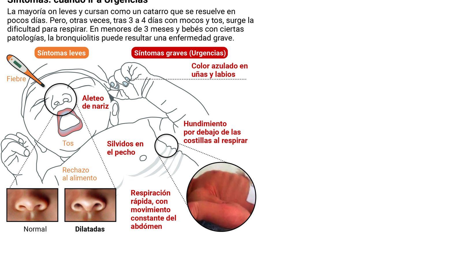 Síntomas de la bronquiolitis. Fuente: Andavac Síntomas de la bronquiolitis. Fuente: Andavac