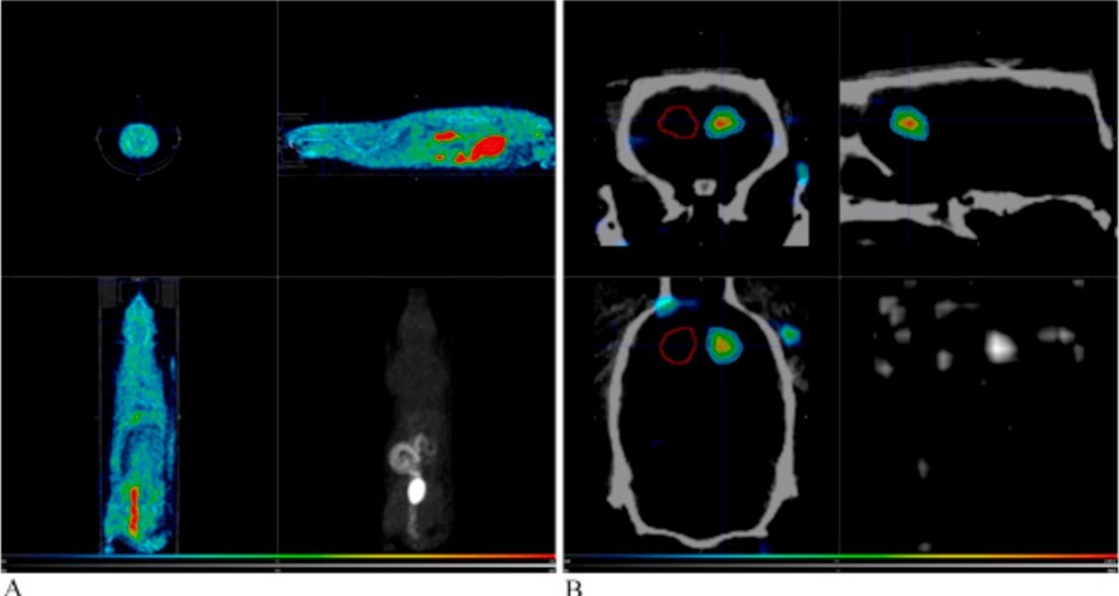 Avances en el manejo terapéutico de la hemorragia subaracnoidea