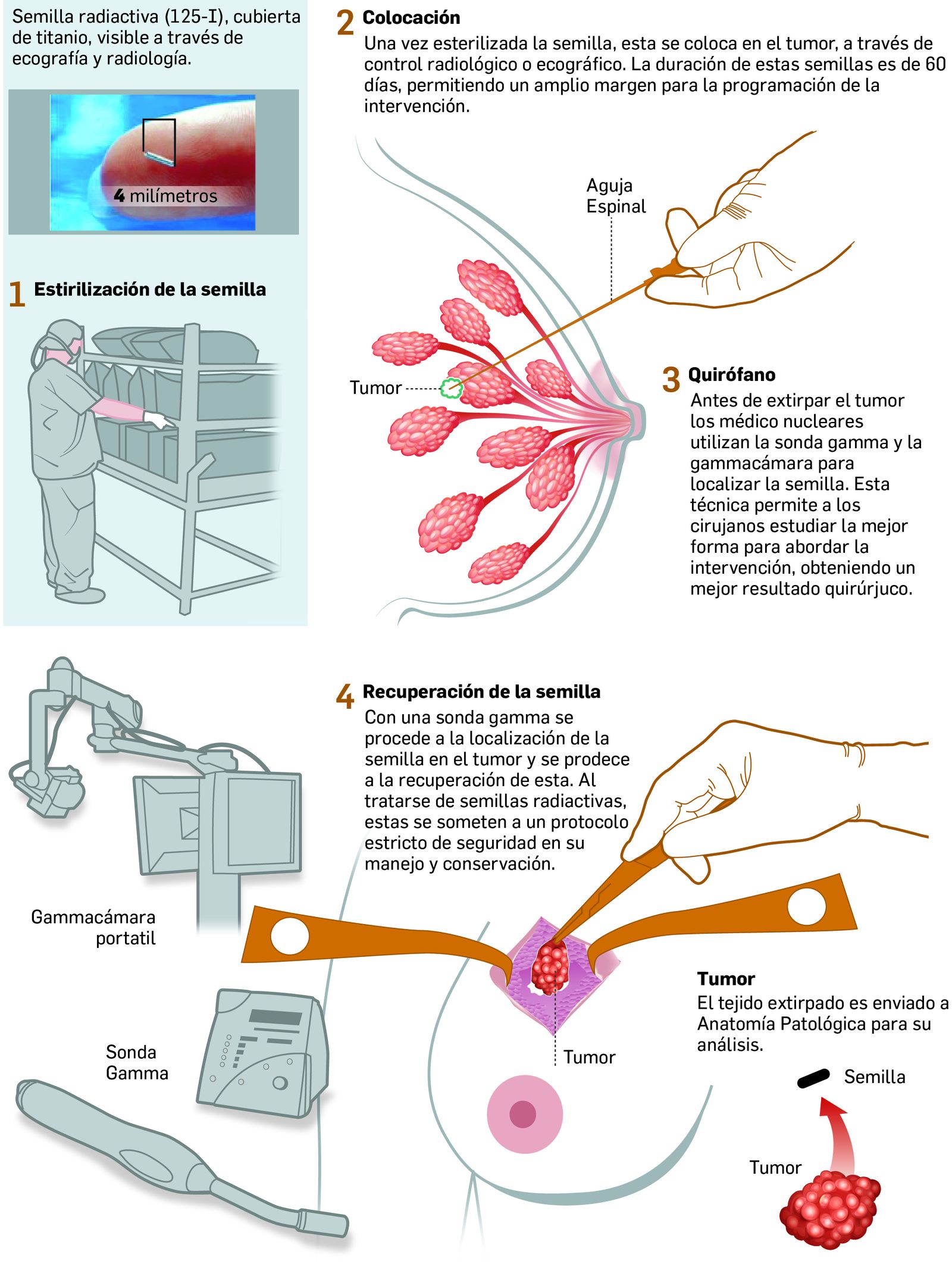 Nueva técnica para localizar tumores no palpables