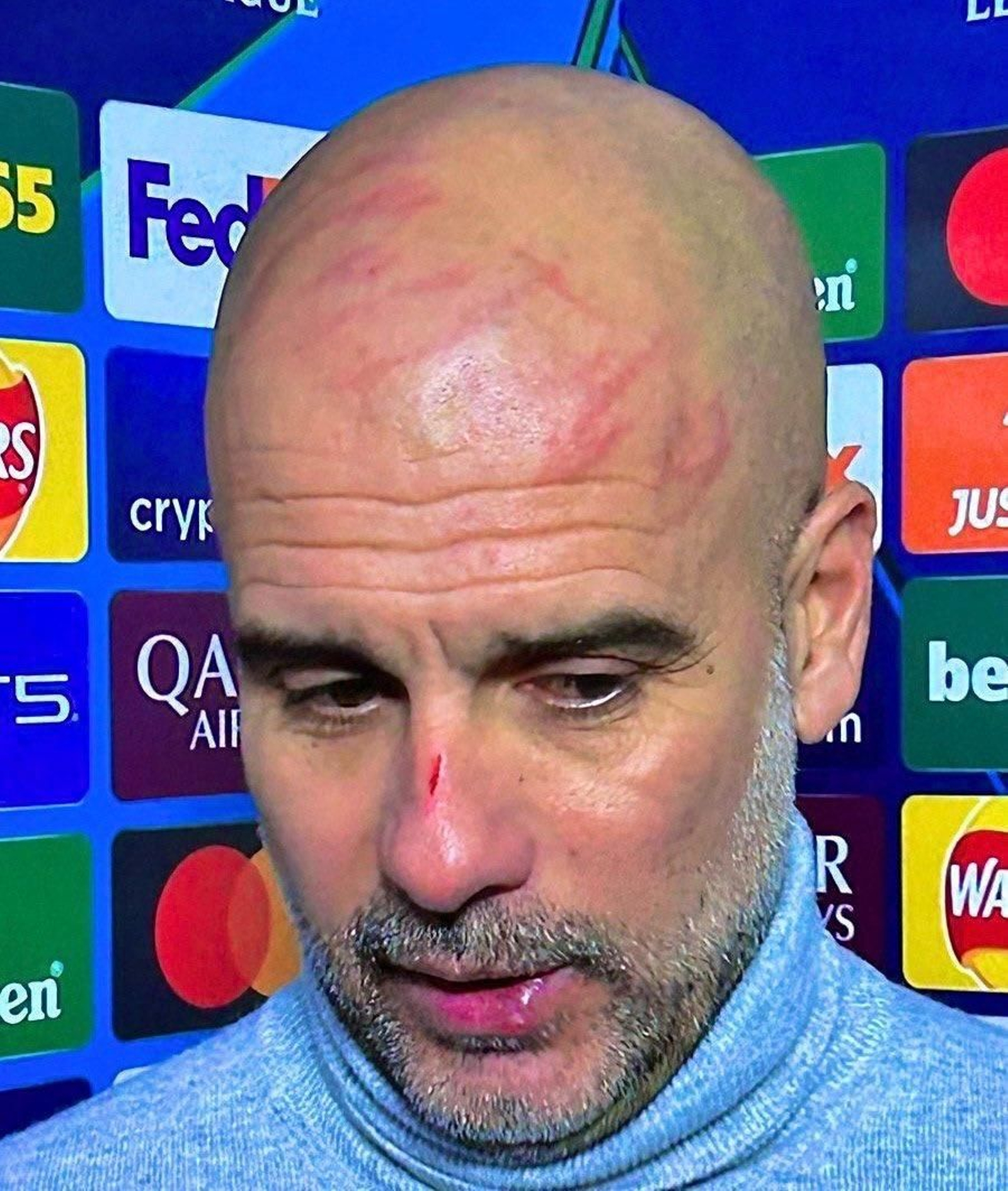 Guardiola, en una captura de pantalla con los visibles arañazos en su cabeza.