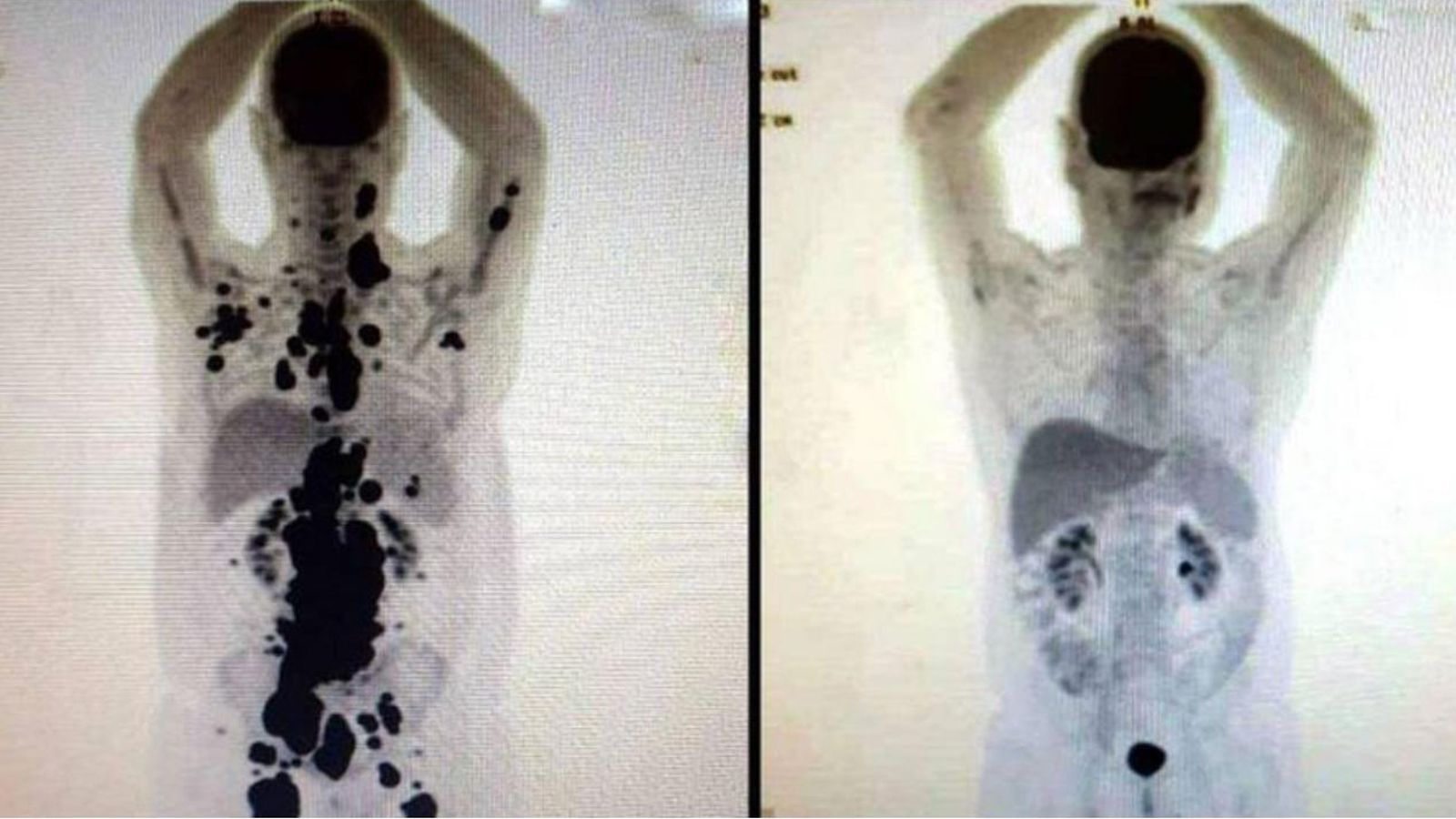 PAULO PEREGRINO, CASO DE CÁNCER REMISIÓN