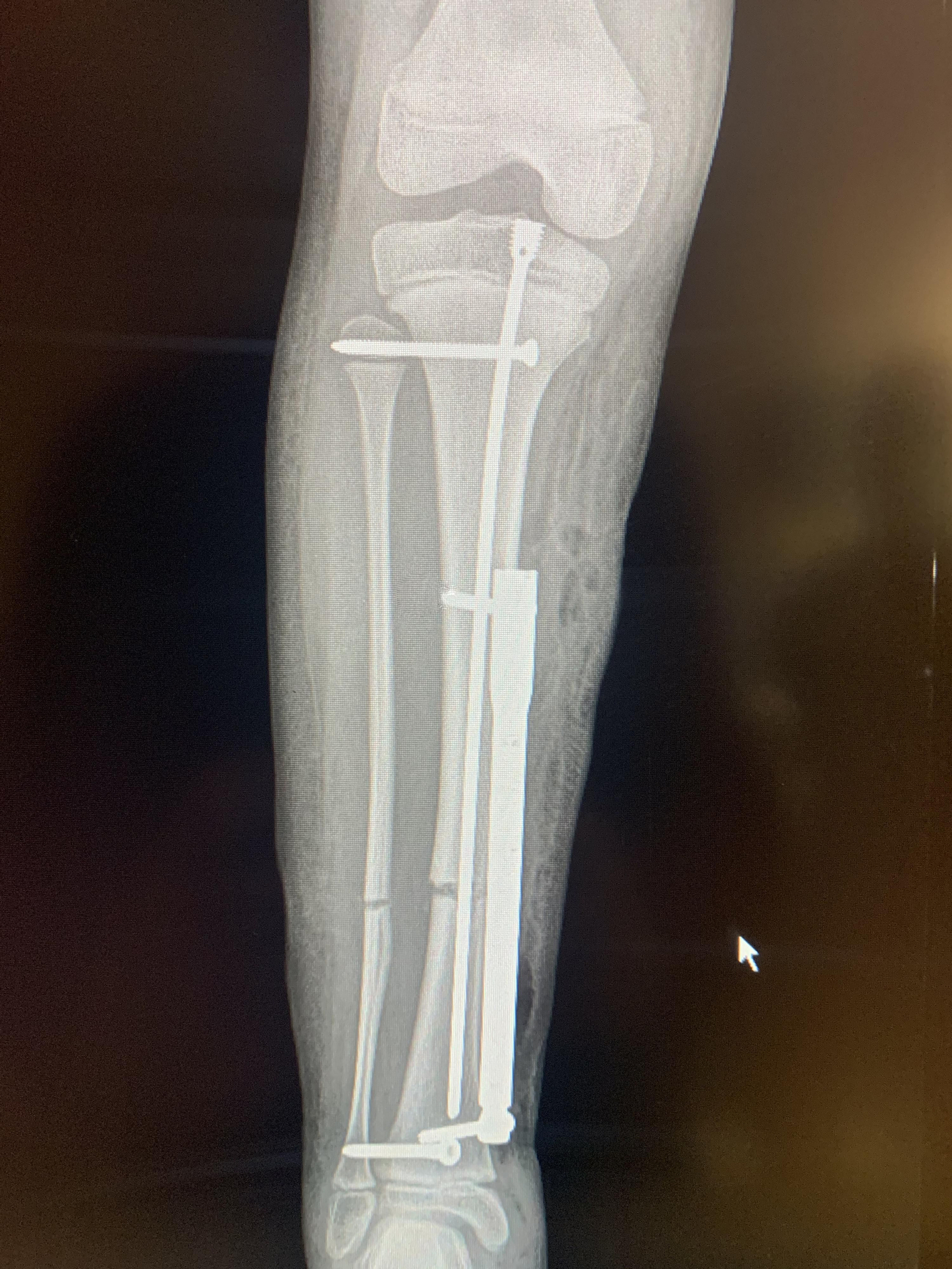 La imagen muestra el dispositivo de alargamiento del hueso.