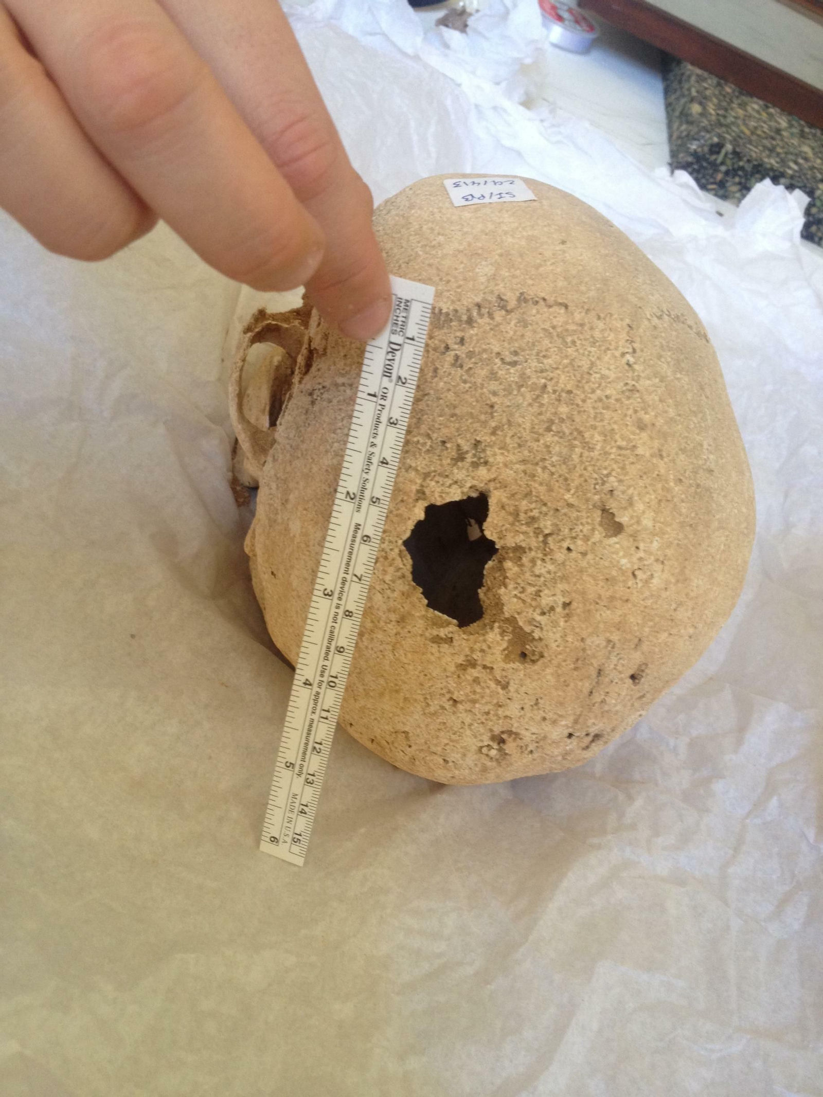 La trepanación del cráneo de Los Alcores