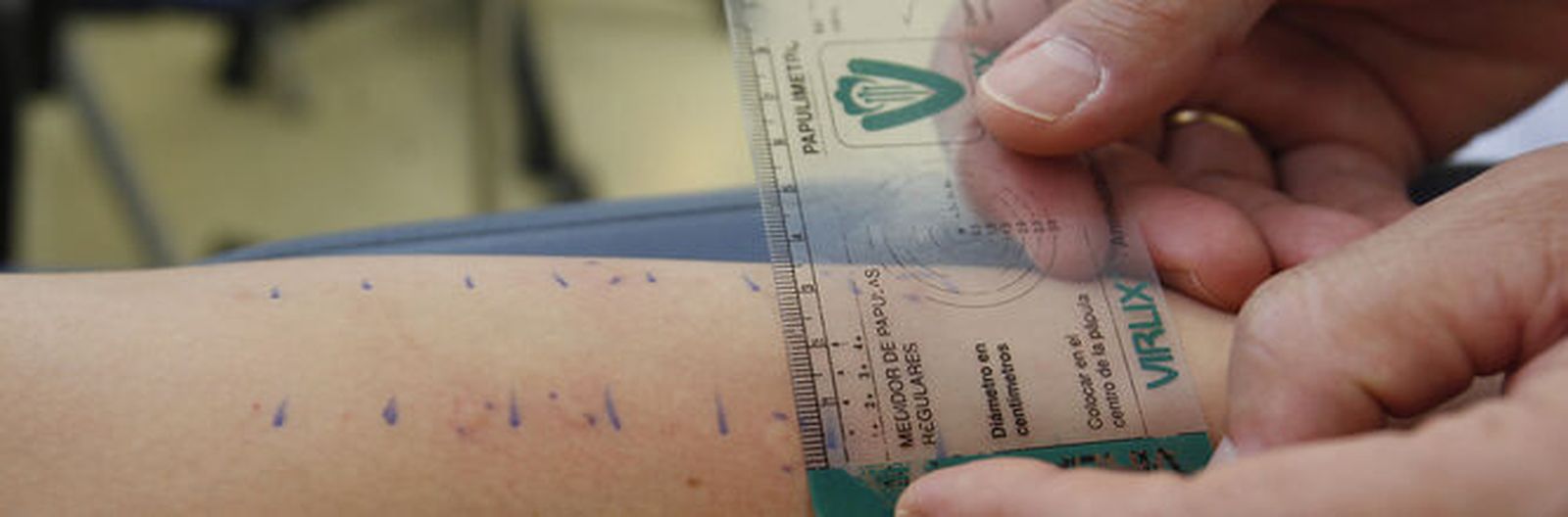 Medición de la reacción alérgica.