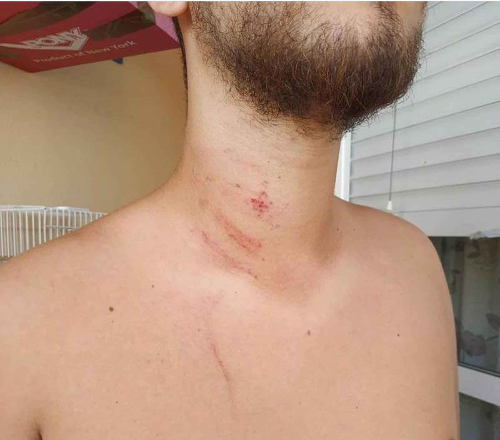 Estado que presentaba el cuello de Abel Bayard el día de la agresión.