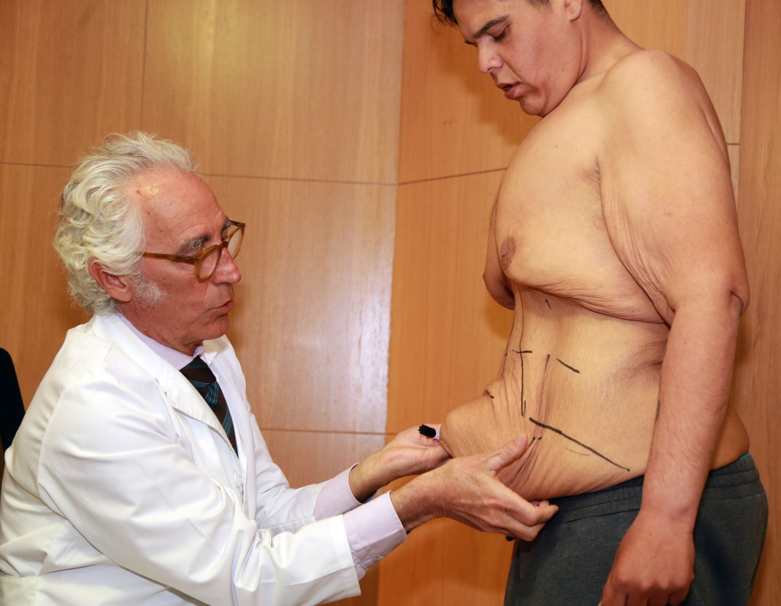 Juan Manuel Heredia, el algecireño que se convirtió en el hombre más obeso del país, antes y después de su primera intervención.