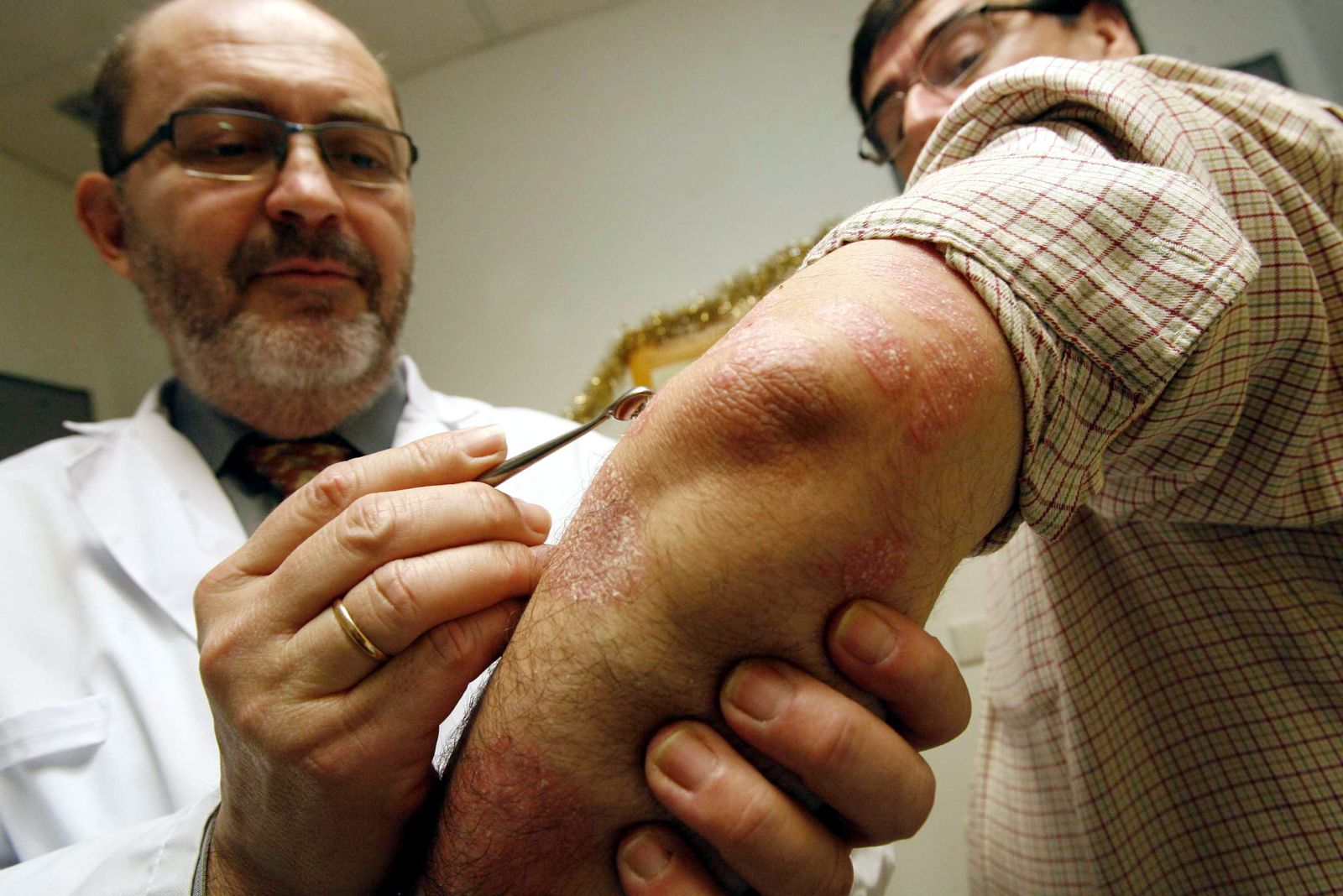 La morfología de las lesiones y de su distribución permiten determinar el tipo de psoriasis.