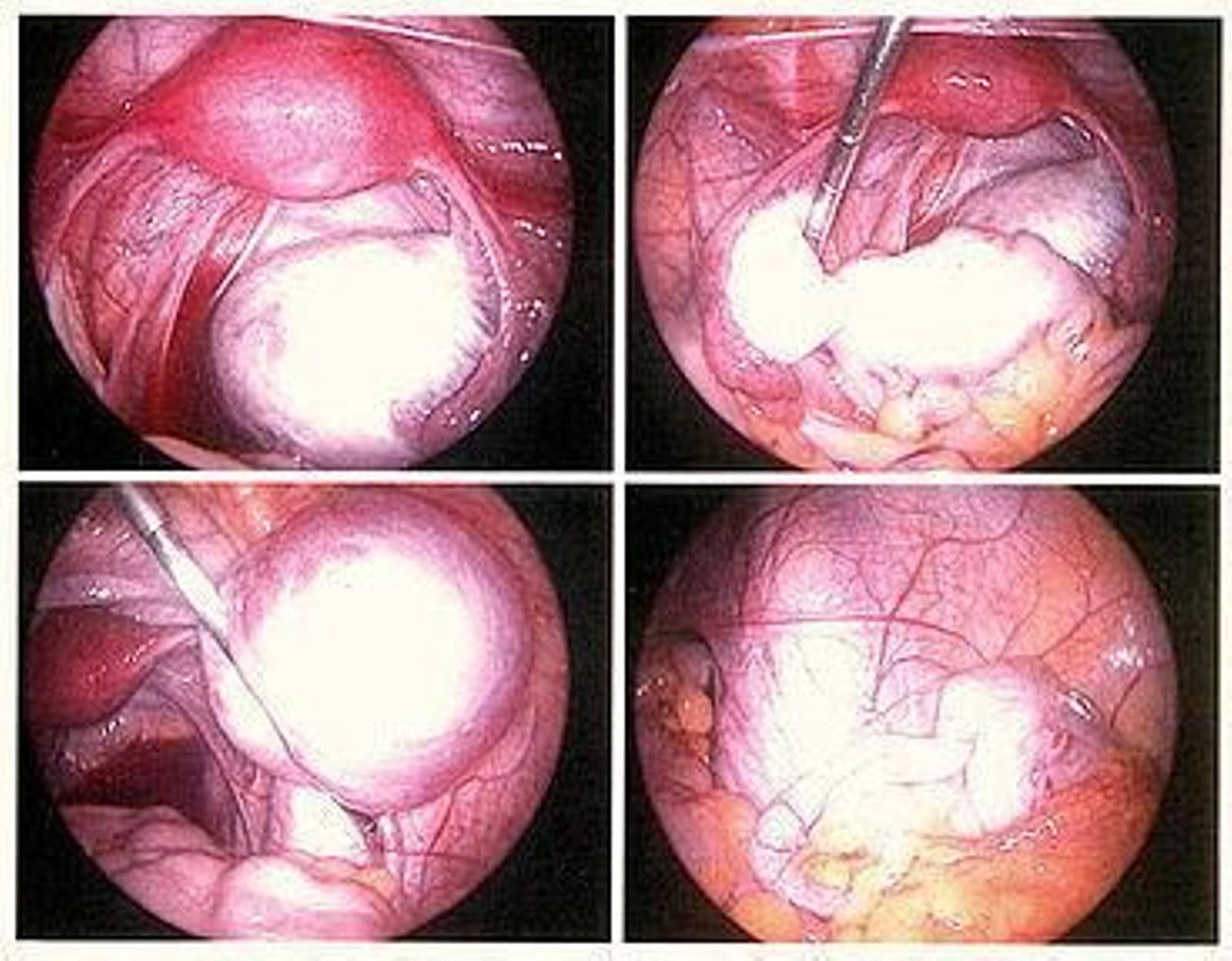 Investigadores descubren la causa genética de la endiometriosis