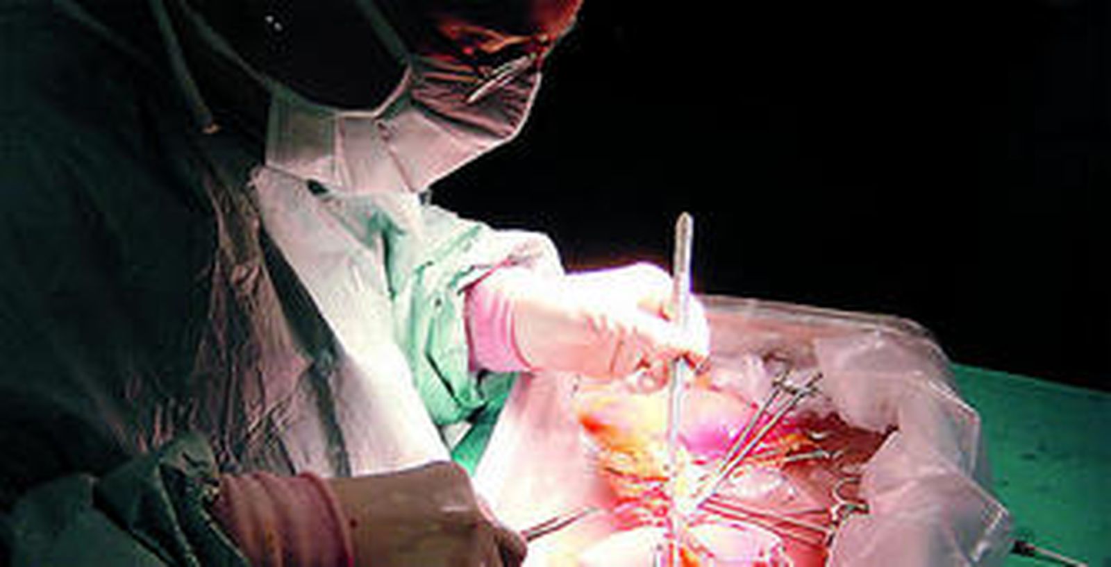 Imagen de una intervención quirúrgica para el trasplante de un corazón.