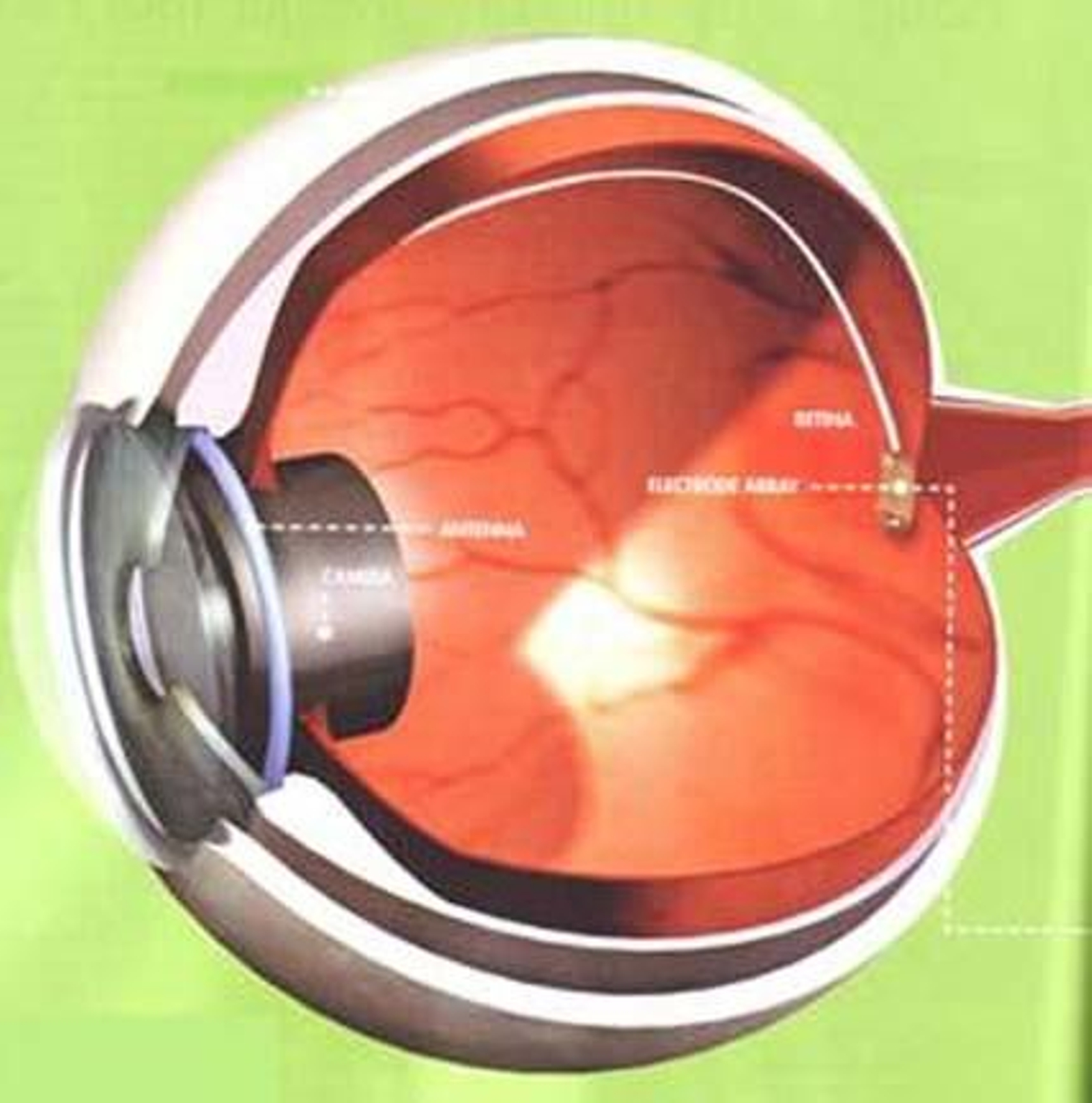 Un ojo biónico permite a un invidente ver luz después de 30 años