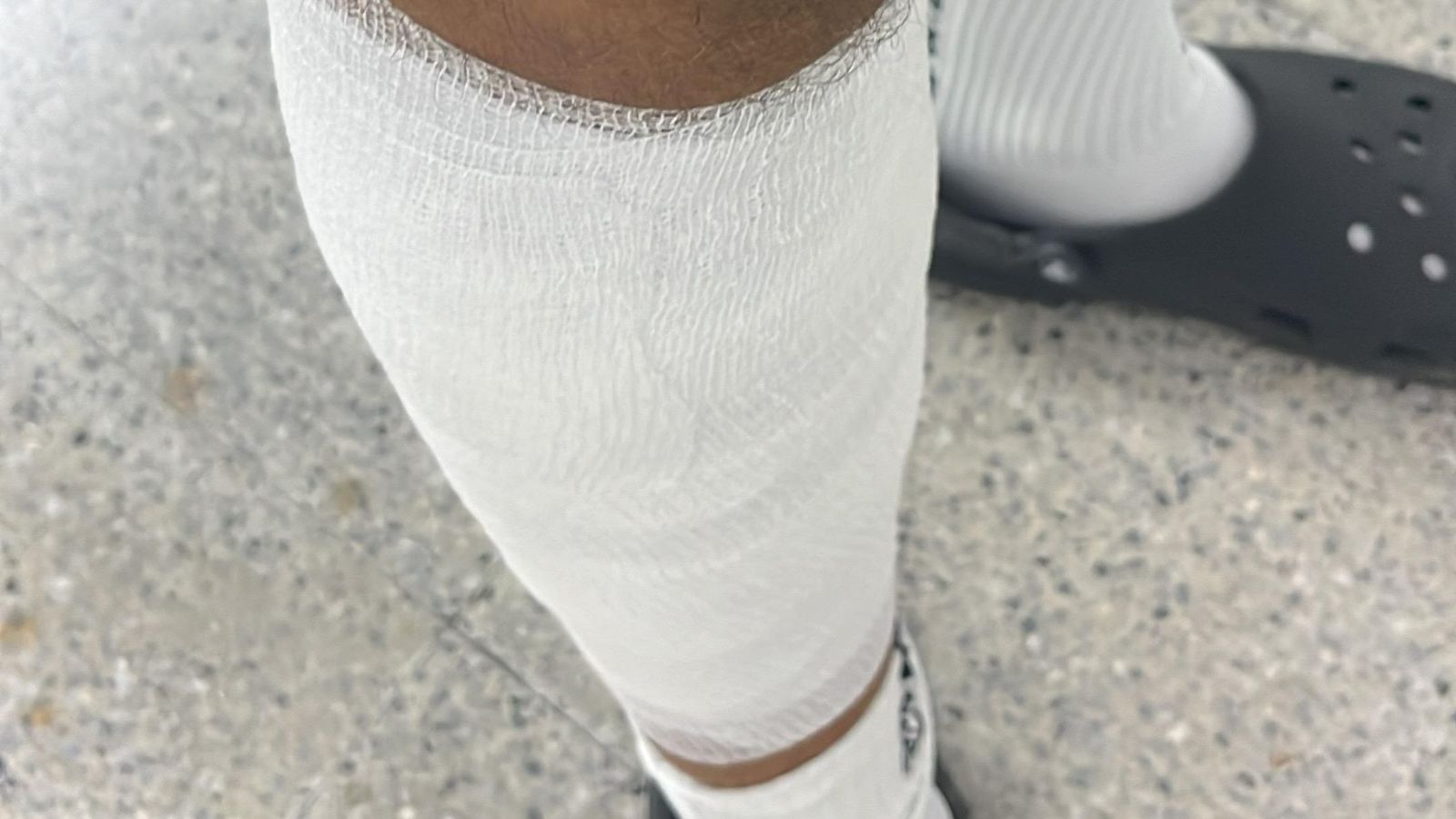 El vendaje de Miguel Ángel González Tinoco en su pierna derecha.