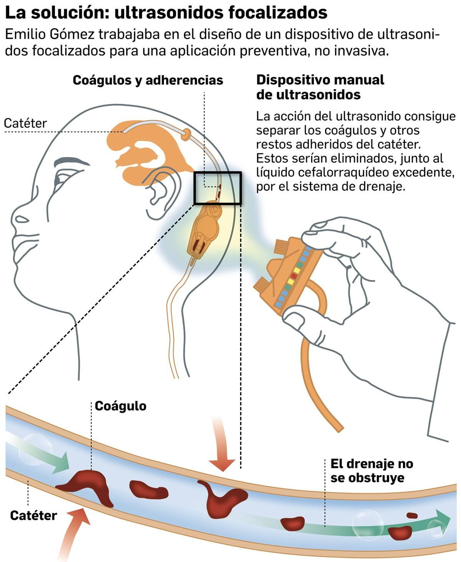 FusClean, la solución planteada. Fuente: catedrático Emilio Gómez y neurocirujano Javier Márquez.