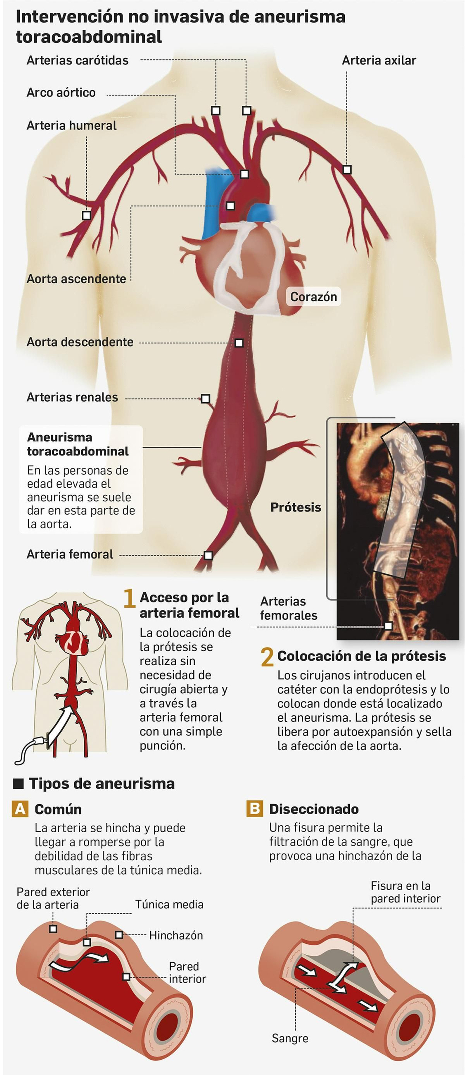 Fuente: Servicio de Angiología y Cirugía Vascular del Hospital Virgen del Rocío. Gráfico: Dpto. de Infografía