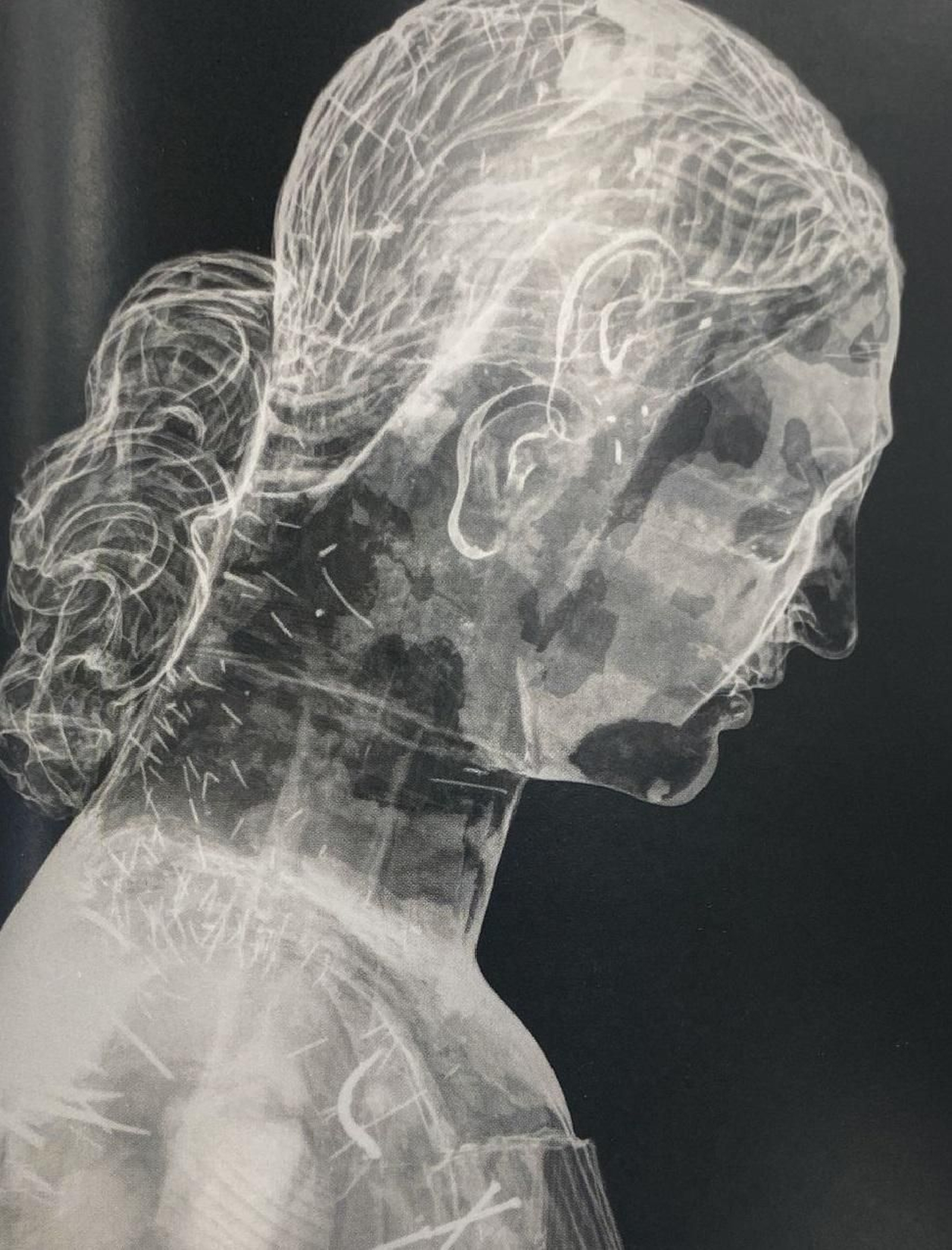 Imagen radiográfica del busto en vista lateral