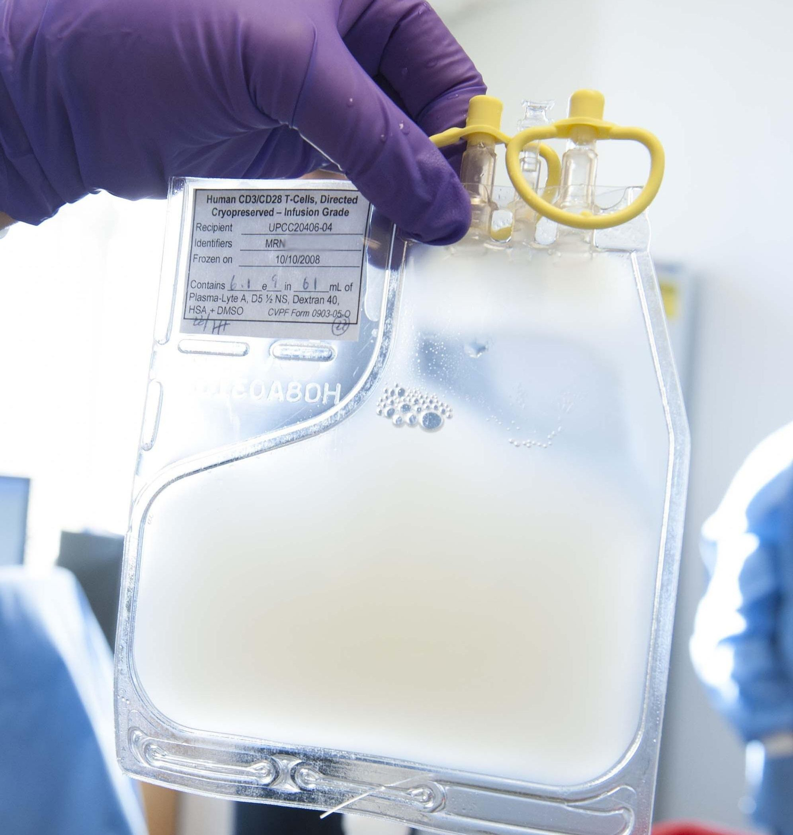 Imagen de archivo de células CAR-T preparadas para su infusión en un paciente.