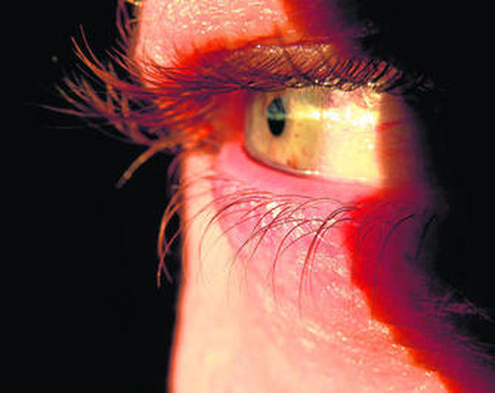 Un ojo humano afectado por una prolongada exposición al sol sin protección.