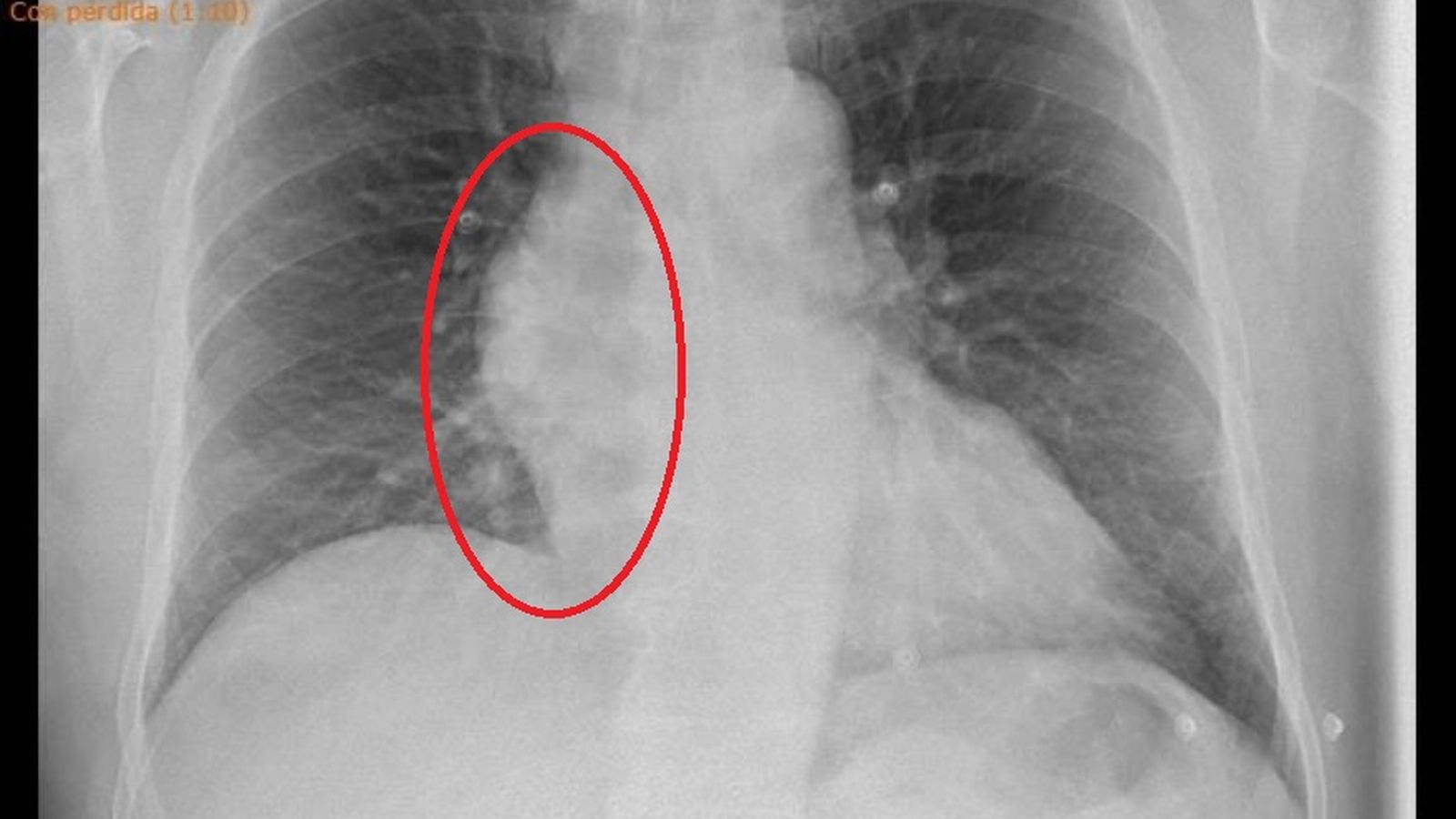 La radiografía de tórax del paciente que muestra un marcado ensanchamiento mediastínico, según explica la reclamación presentada por la familia.