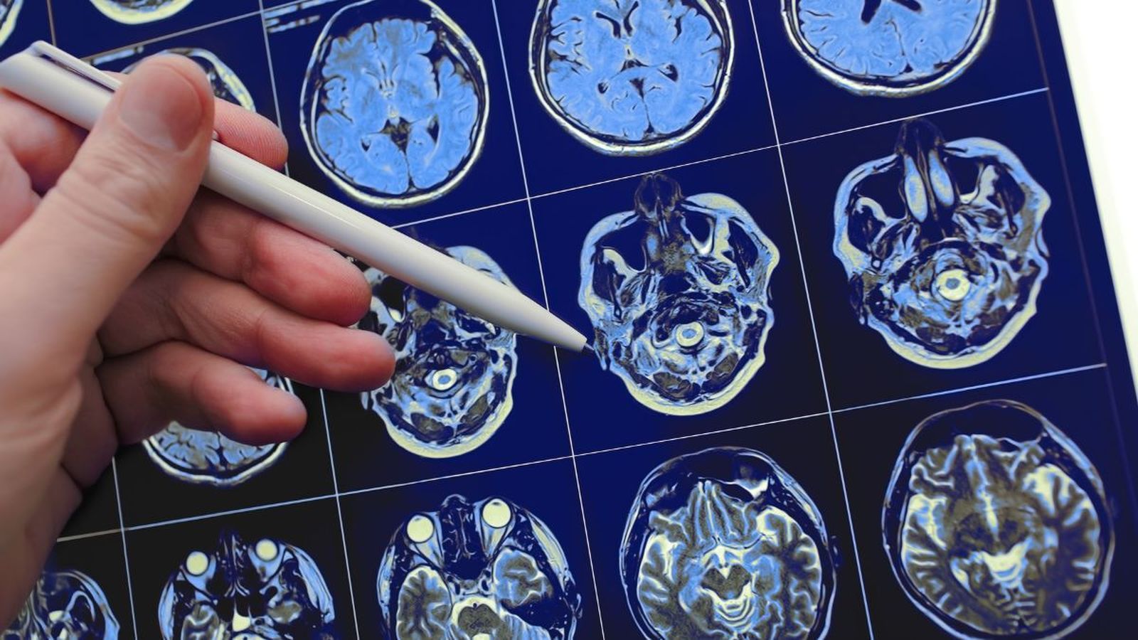 ¿Qué puede provocar un ataque de epilepsia?