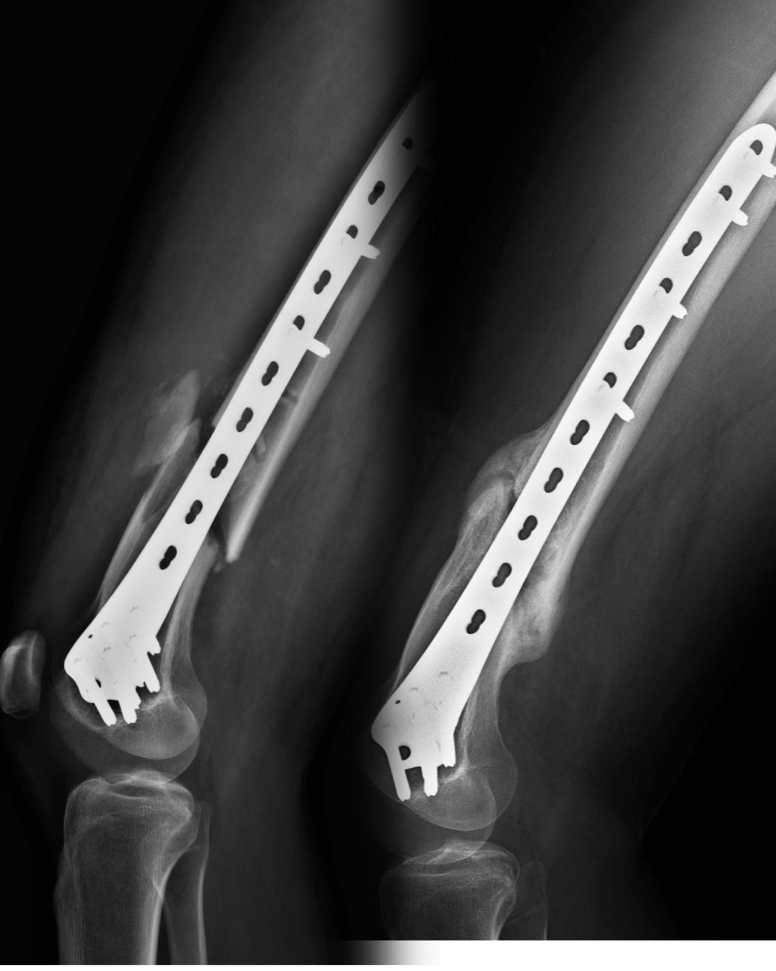 Radigrafía de una fractura en la que se ha empleado un tratamiento con ondas de choque.