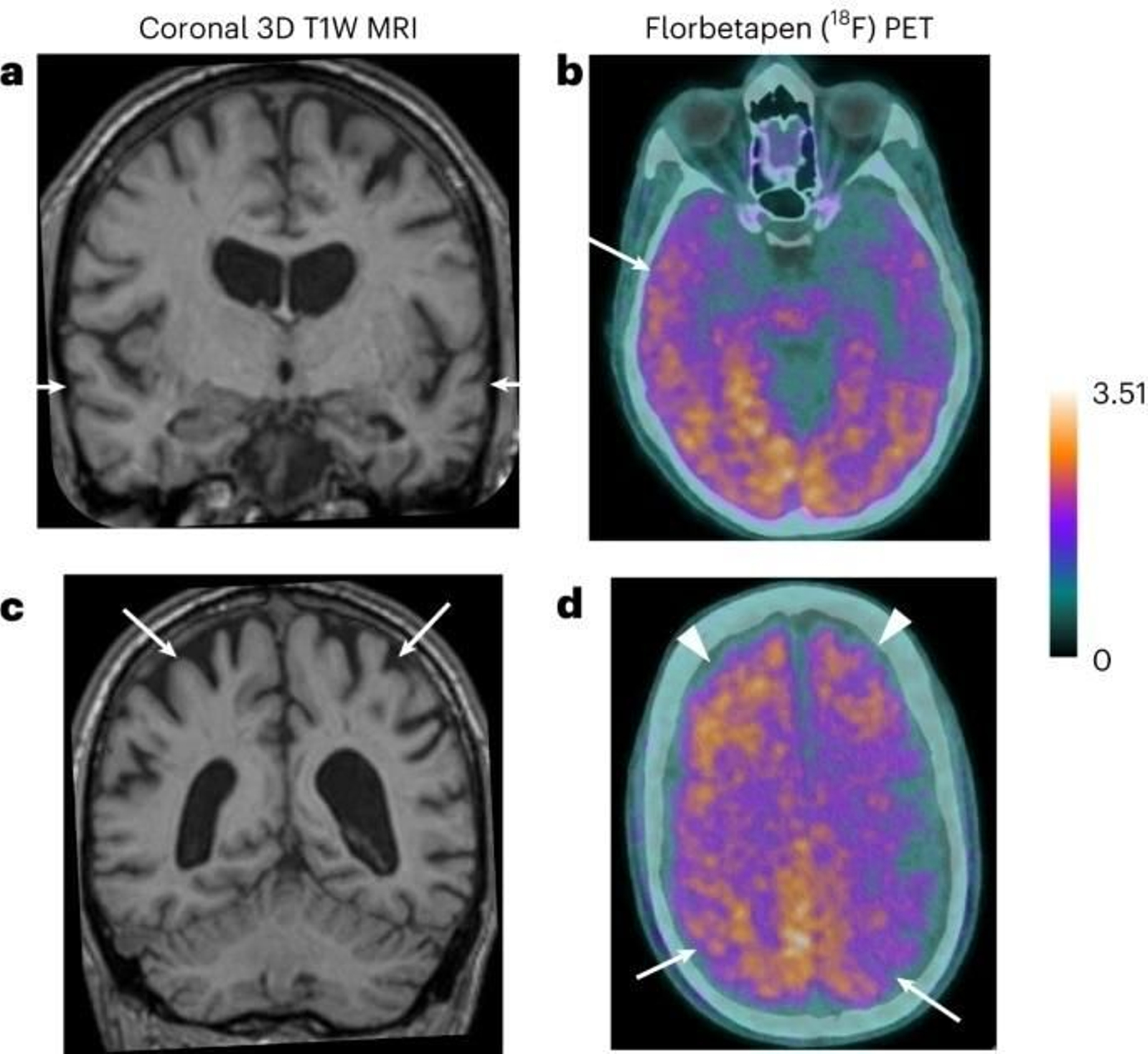 Imagen del estudio realizado para describir los primeros casos de transmisión del alzheimer