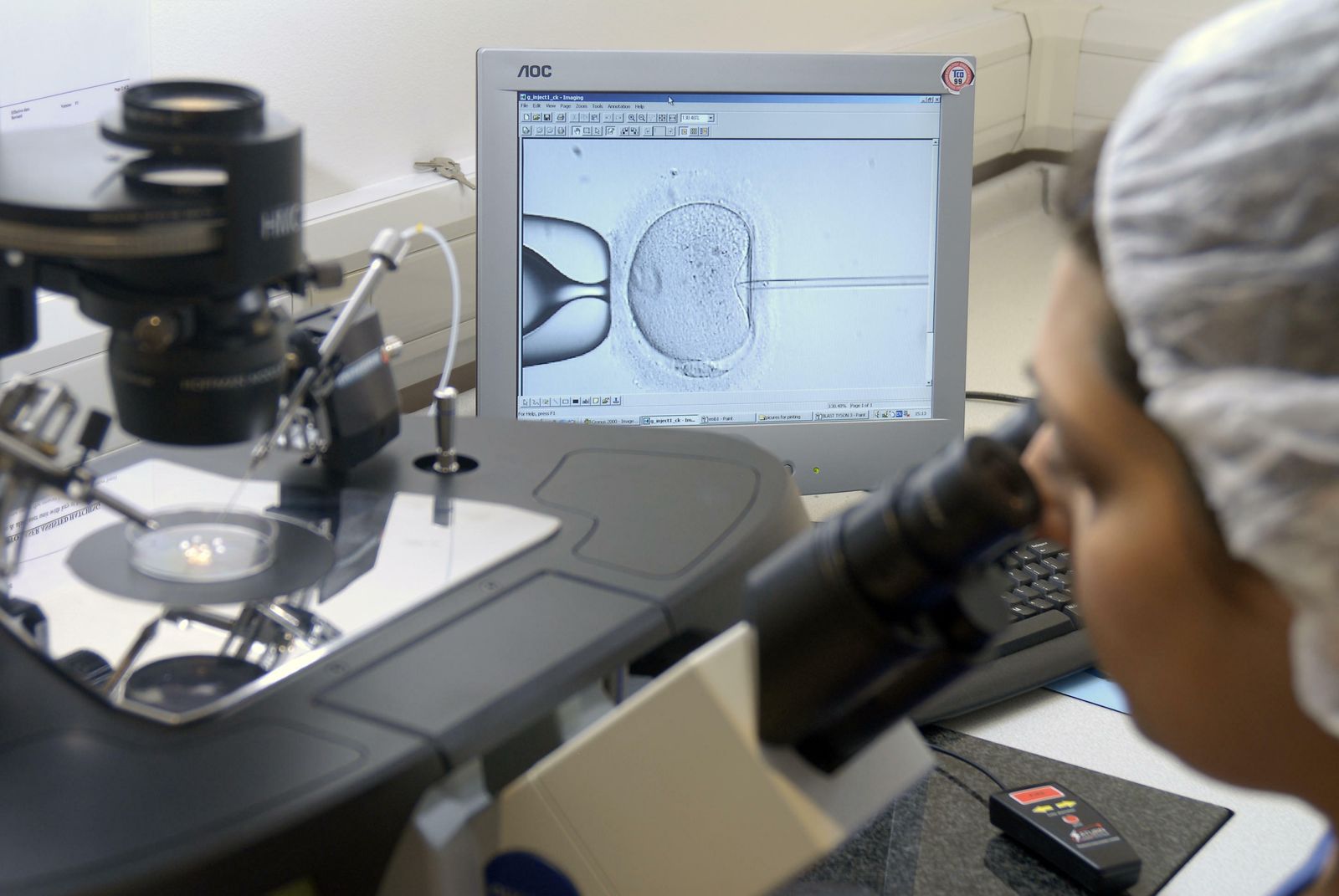 Proceso de fecundación in  vitro con técnicas de inyección intracitoplasmática.