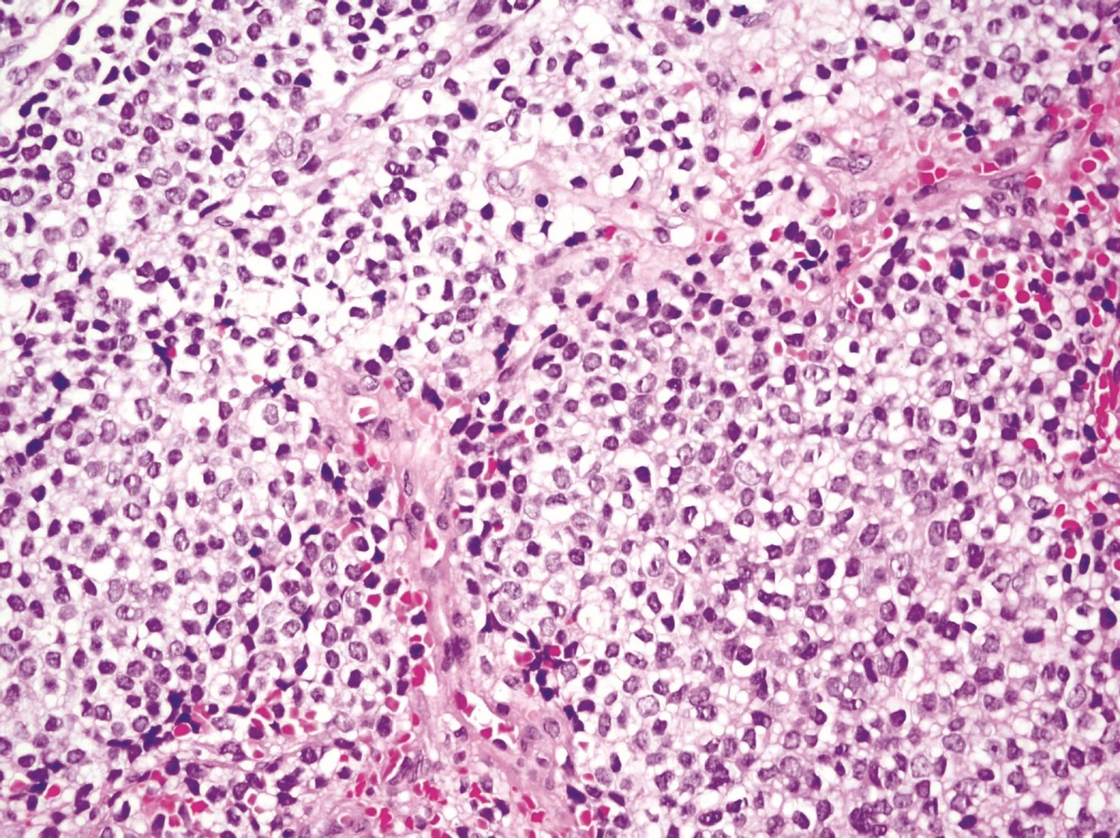 Sarcoma de Ewing